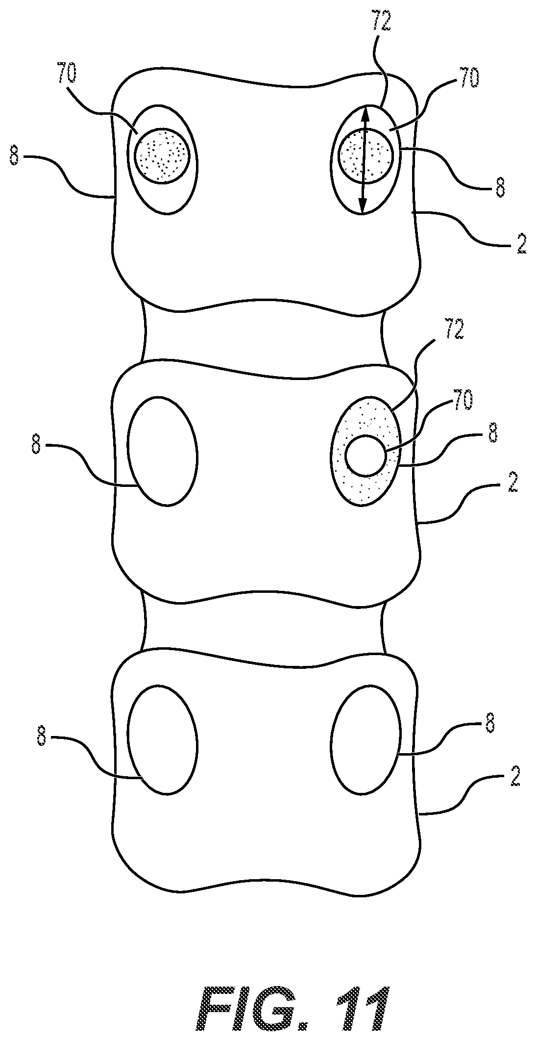 Patent US12551241 Figure 8 – Expandable bone core for pedicle screw fixation