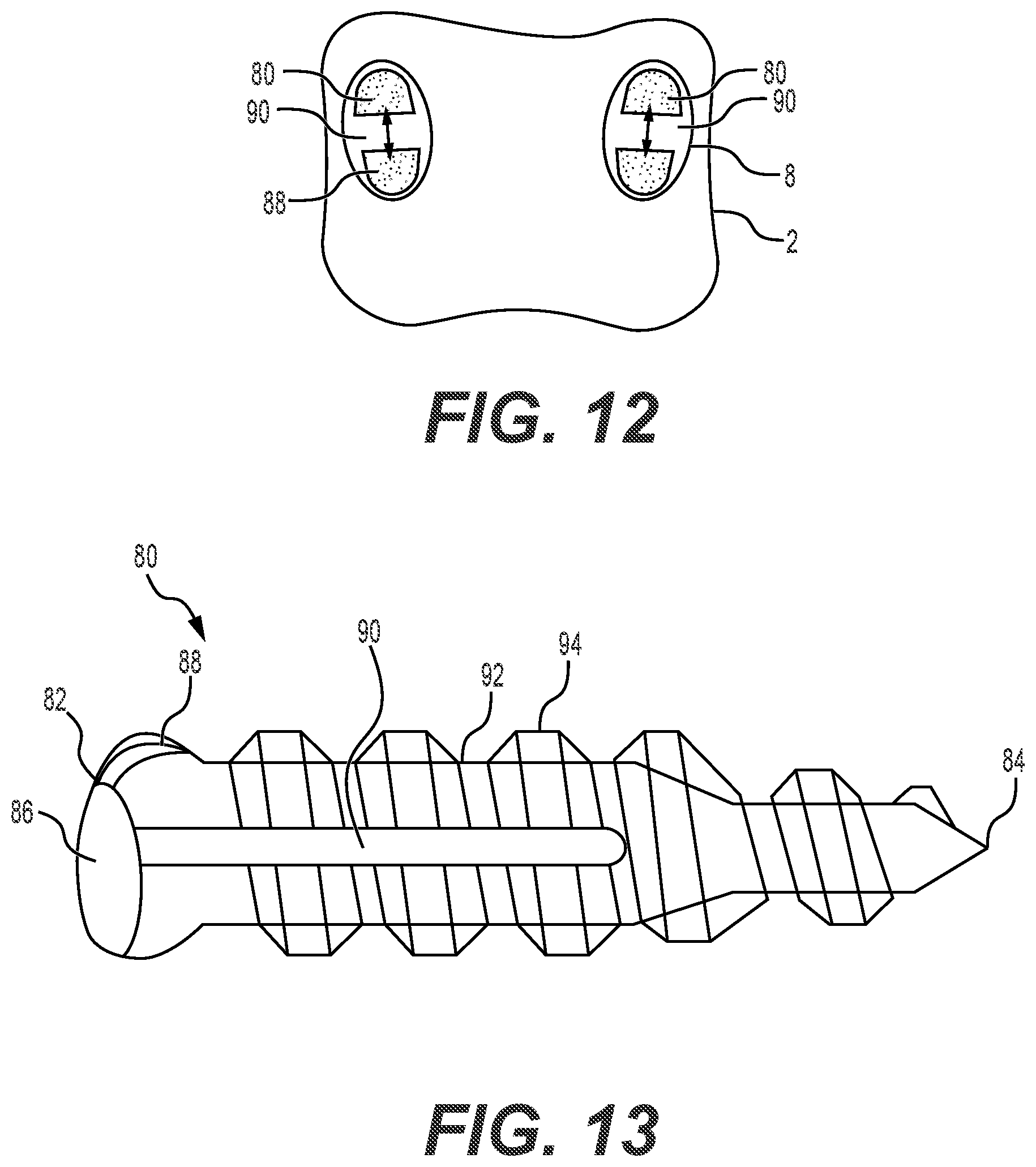Patent US12551241 Figure 9 – Expandable bone core for pedicle screw fixation
