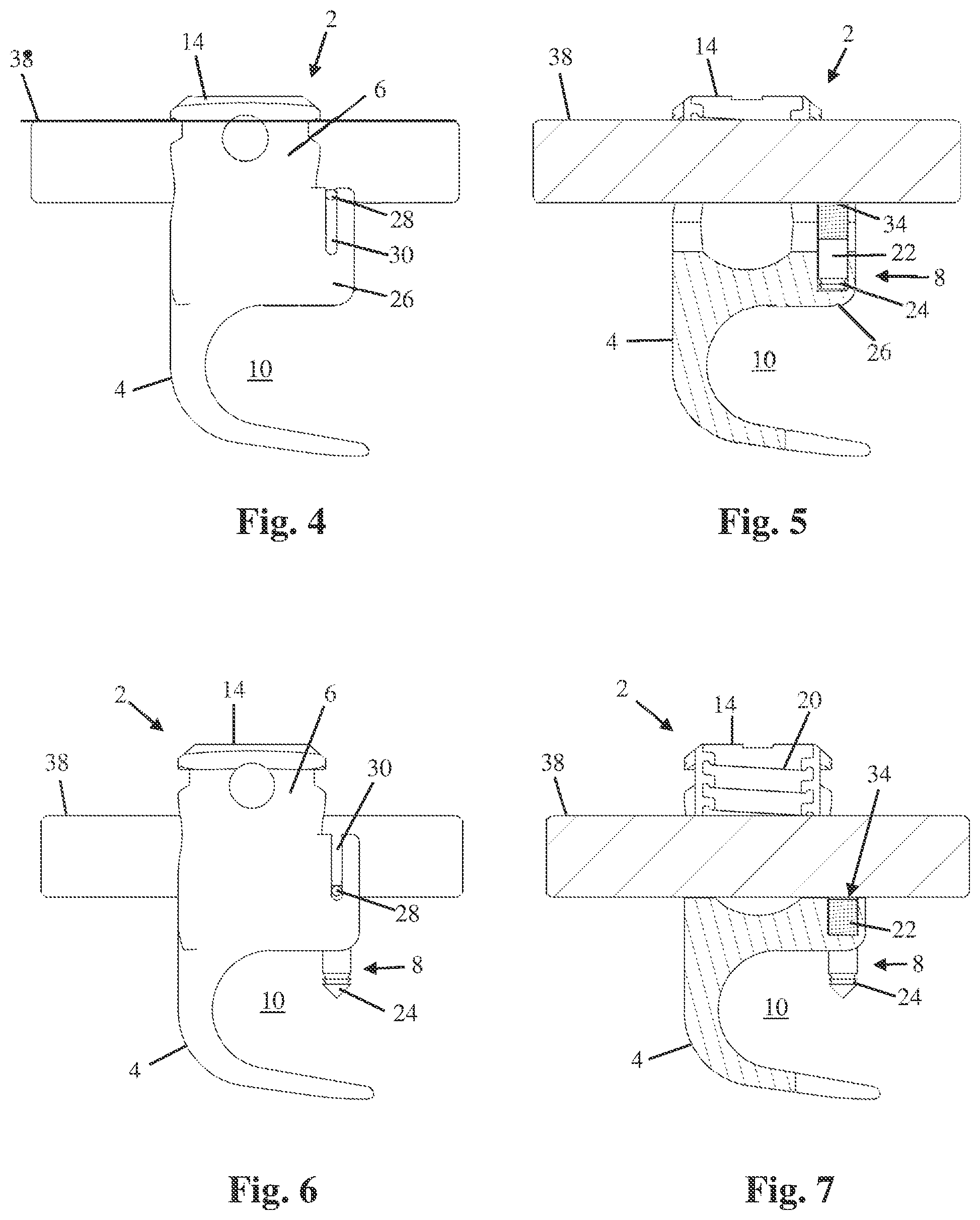 Patent US12551242 Figure 2 – Bone anchor with deployable purchase element