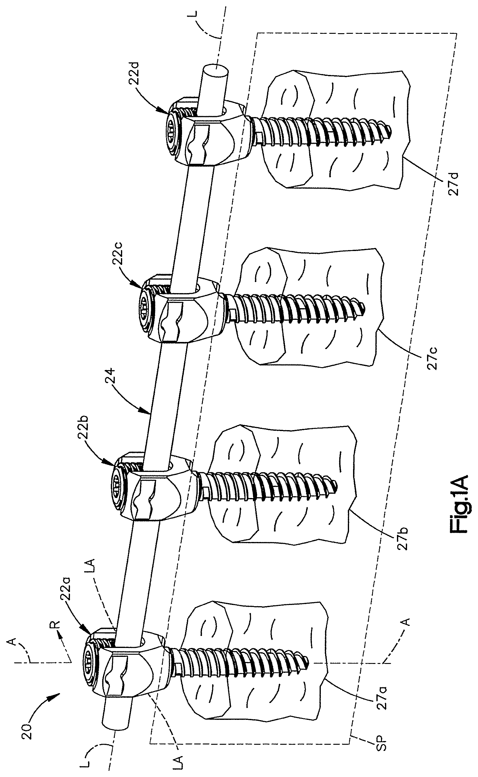 Patent US12551245 — Uni-planer bone fixation assembly — Figure 1