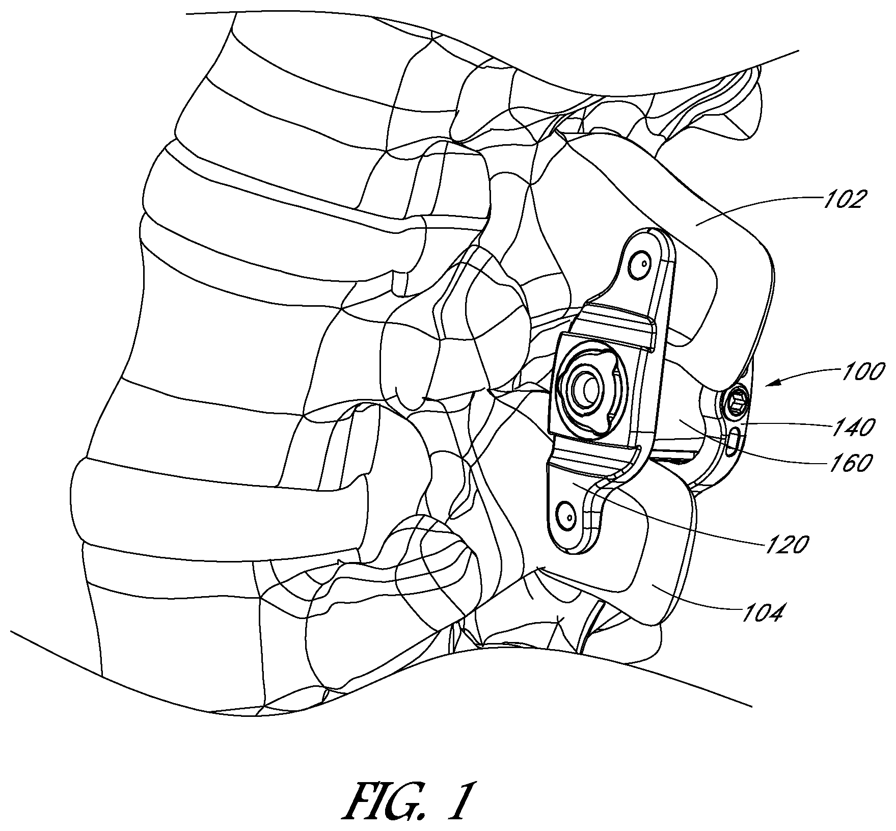 Patent US12551246 Figure 1 – Apparatus and method of treating spinous processes