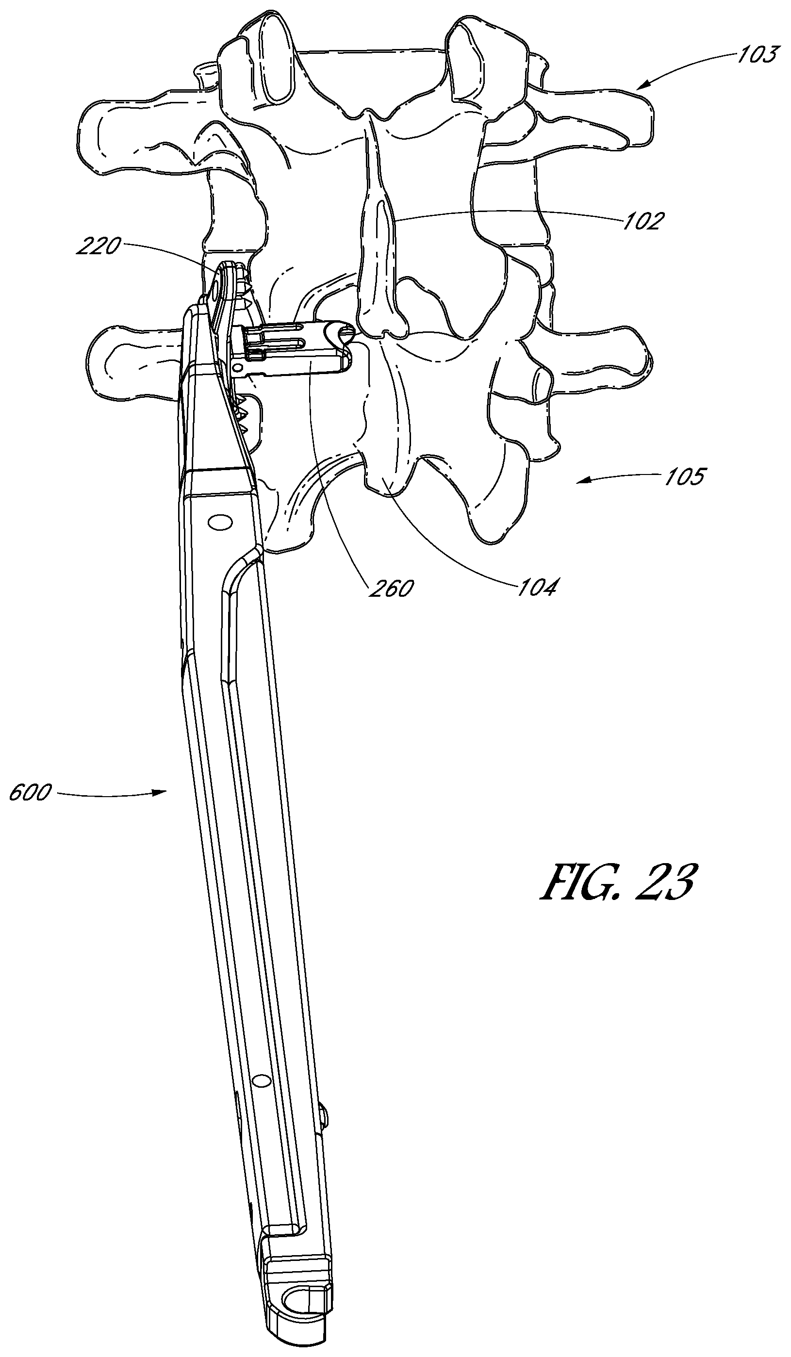 Patent US12551246 Figure 15 – Apparatus and method of treating spinous processes
