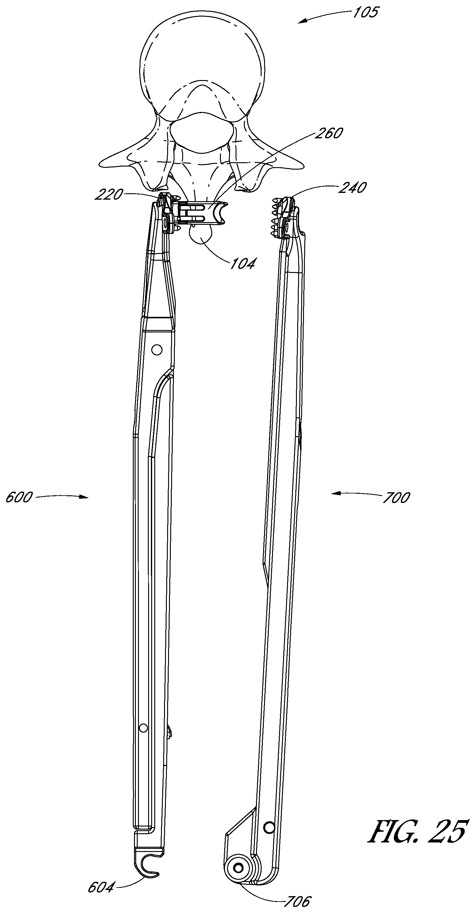 Patent US12551246 Figure 17 – Apparatus and method of treating spinous processes
