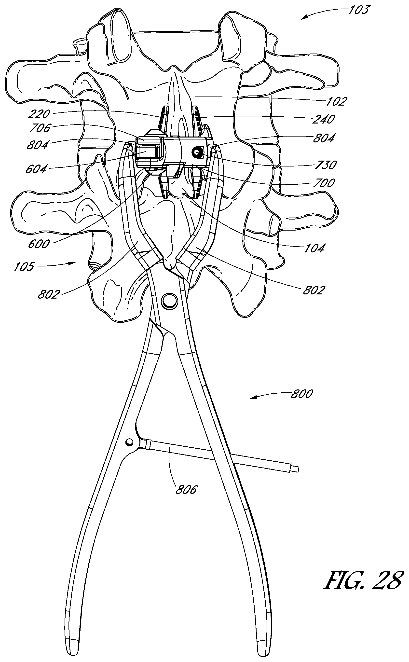 Patent US12551246 Figure 20 – Apparatus and method of treating spinous processes