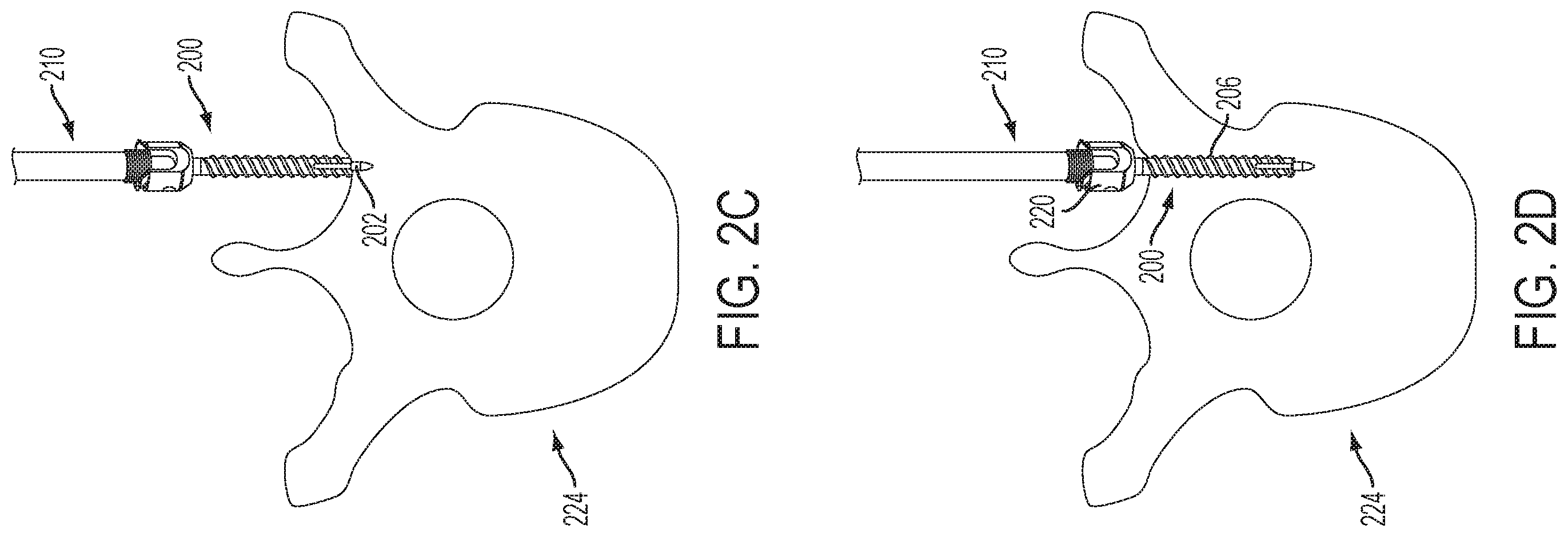 Patent US12551247 Figure 4 – Bone anchors and surgical instruments with integrated guide tips