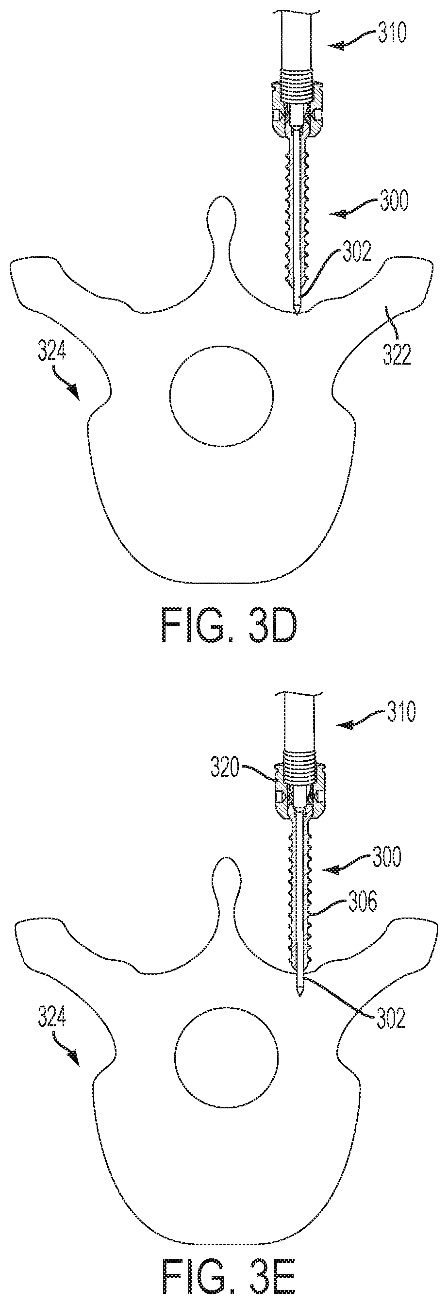 Patent US12551247 Figure 7 – Bone anchors and surgical instruments with integrated guide tips