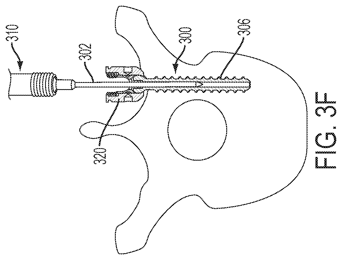 Patent US12551247 Figure 8 – Bone anchors and surgical instruments with integrated guide tips