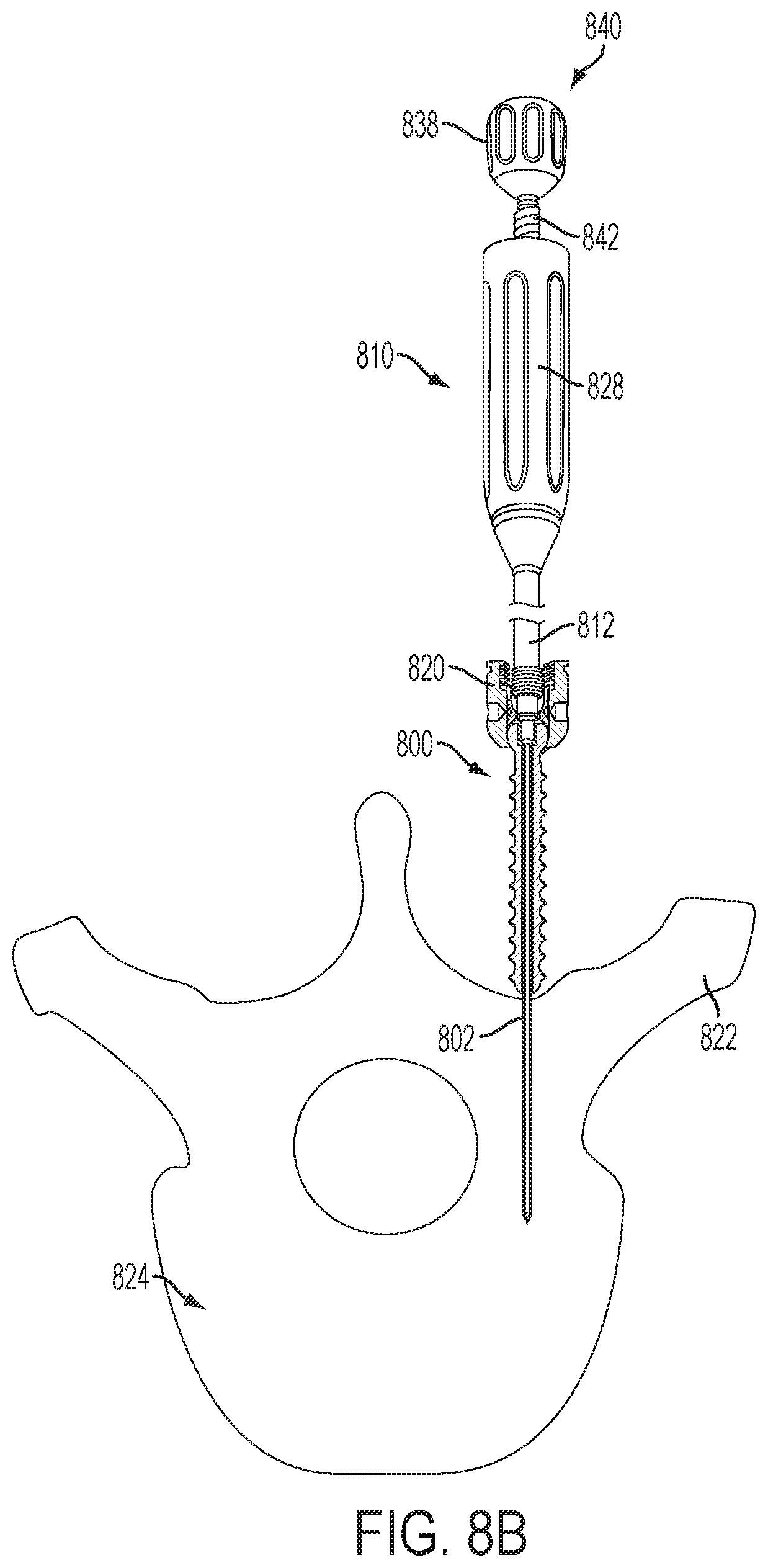 Patent US12551247 Figure 17 – Bone anchors and surgical instruments with integrated guide tips