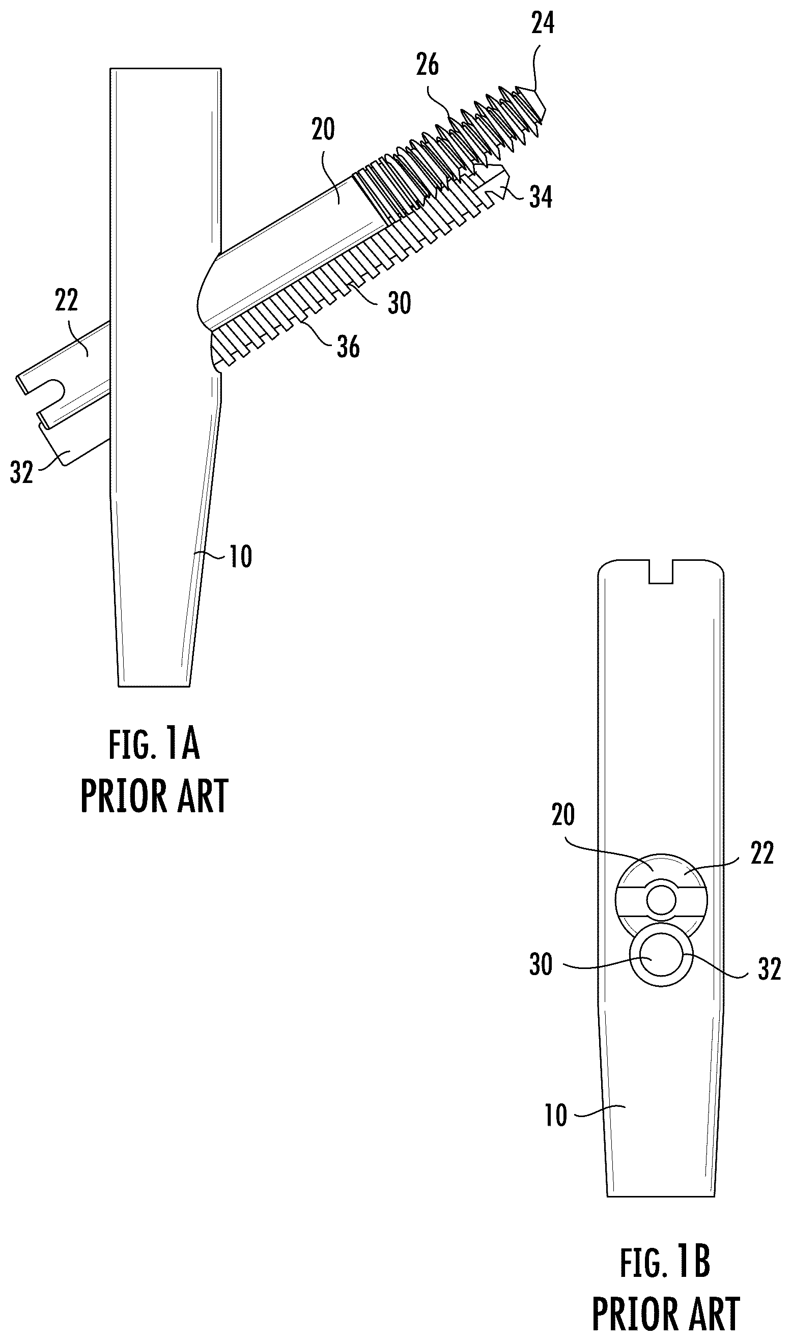Patent US12551249 — Surgical technique for minimizing medialization of an orthopedic intramedullary nail — Figure 1