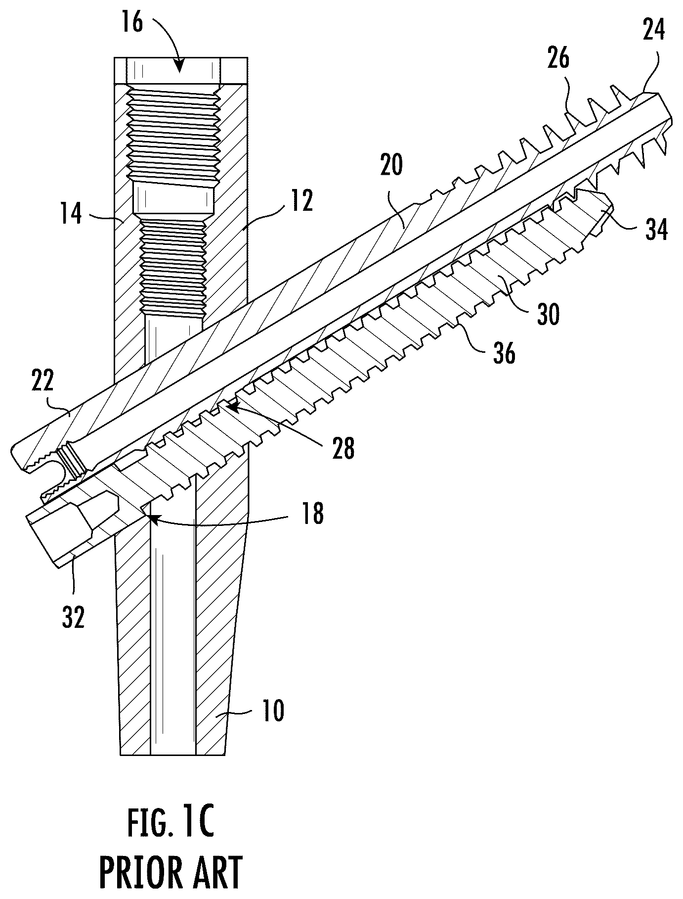 Patent US12551249 Figure 2 – Surgical technique for minimizing medialization of an orthopedic intramedullary nail