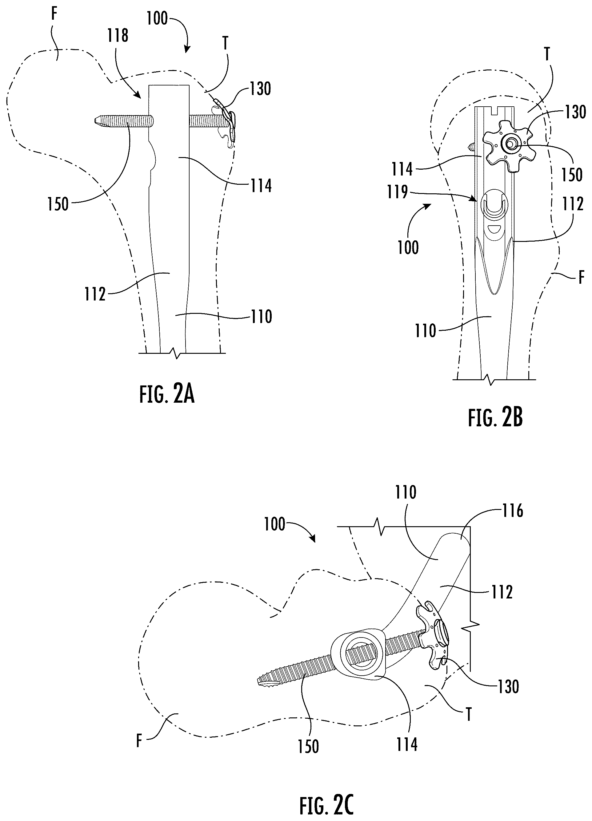 Patent US12551249 Figure 3 – Surgical technique for minimizing medialization of an orthopedic intramedullary nail