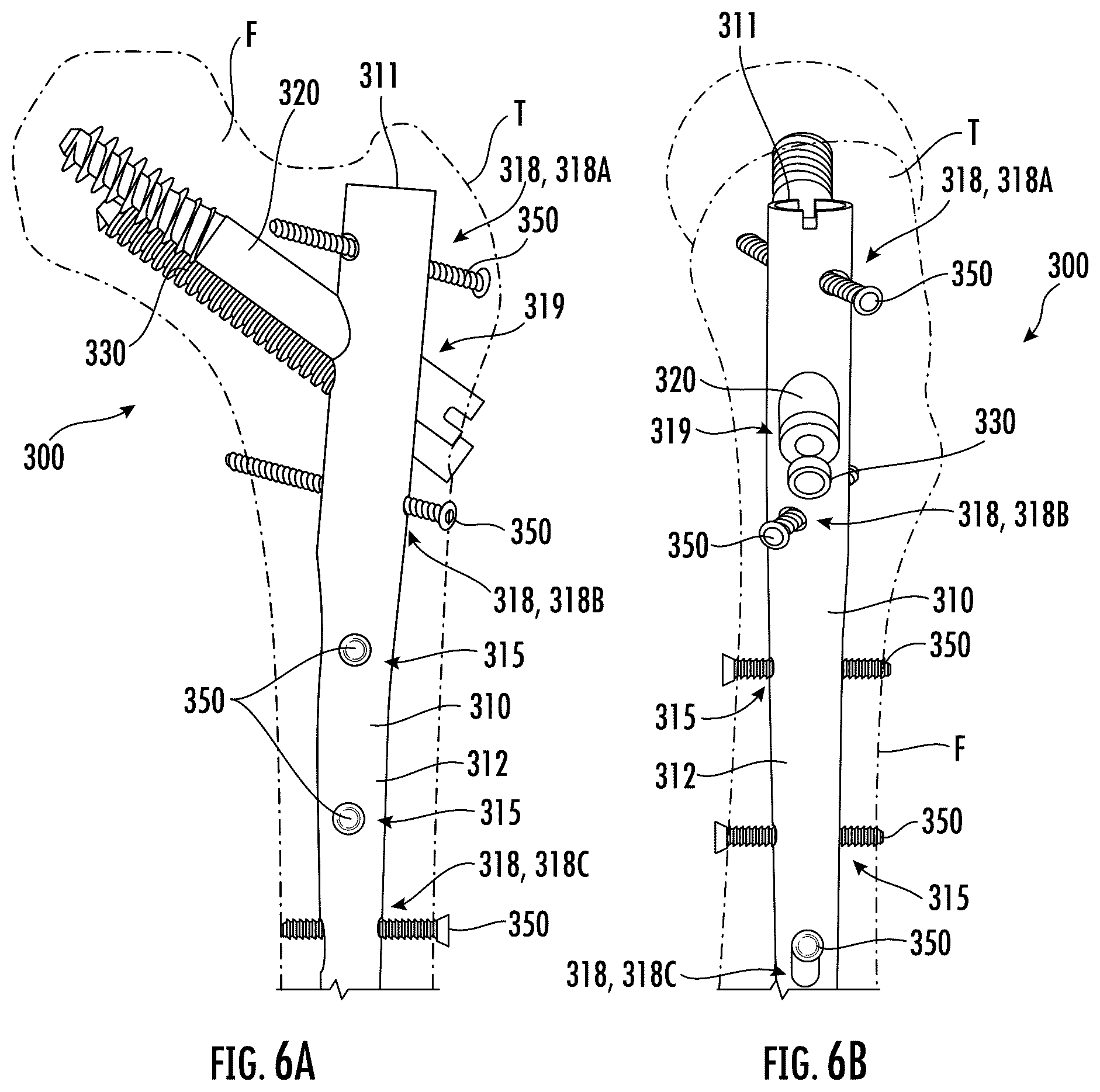 Patent US12551249 Figure 7 – Surgical technique for minimizing medialization of an orthopedic intramedullary nail