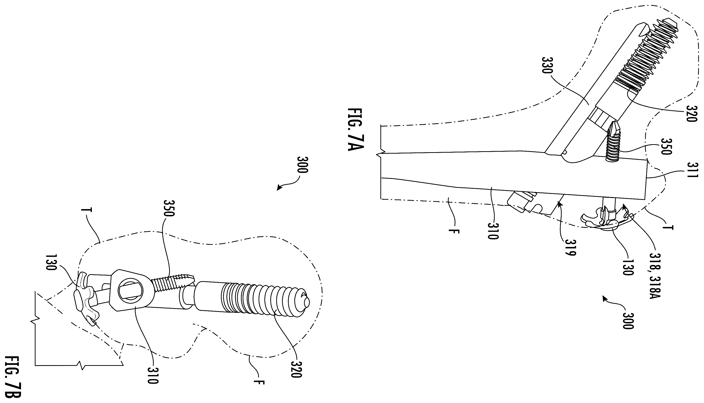 Patent US12551249 Figure 8 – Surgical technique for minimizing medialization of an orthopedic intramedullary nail