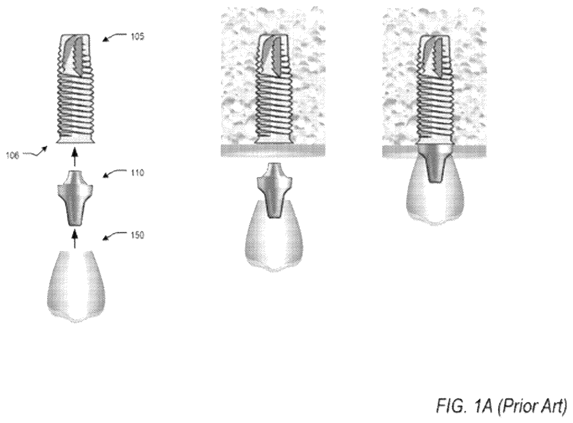 Patent US12551252 Figure 1 – Apparatus and method of an osteotomy for dental implant