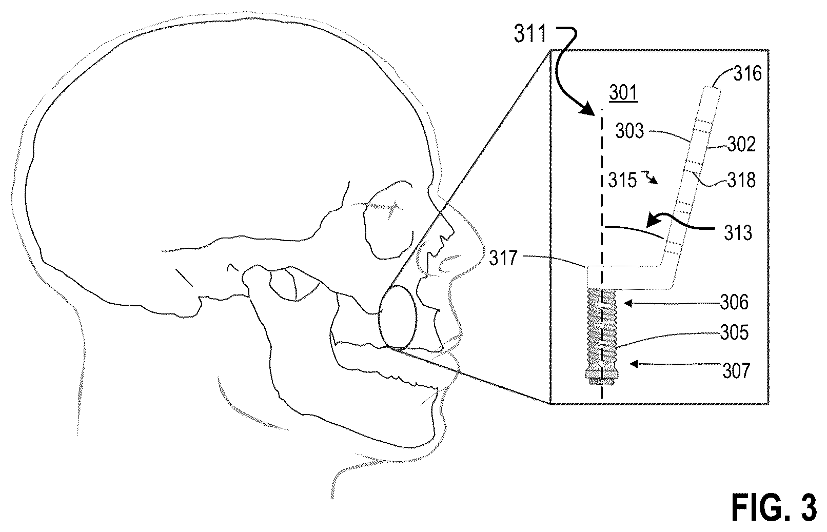 Patent US12551252 Figure 6 – Apparatus and method of an osteotomy for dental implant
