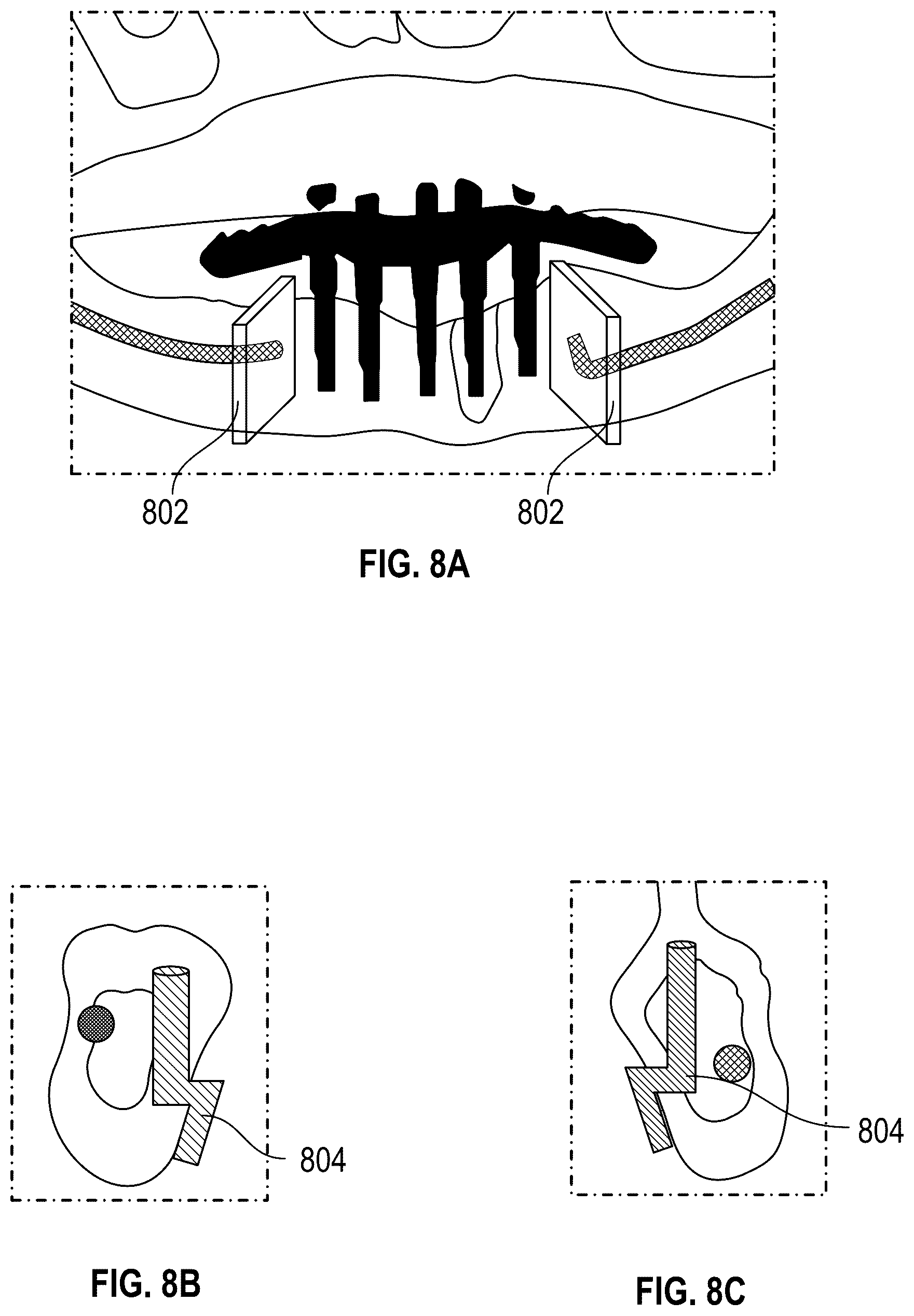Patent US12551252 Figure 13 – Apparatus and method of an osteotomy for dental implant
