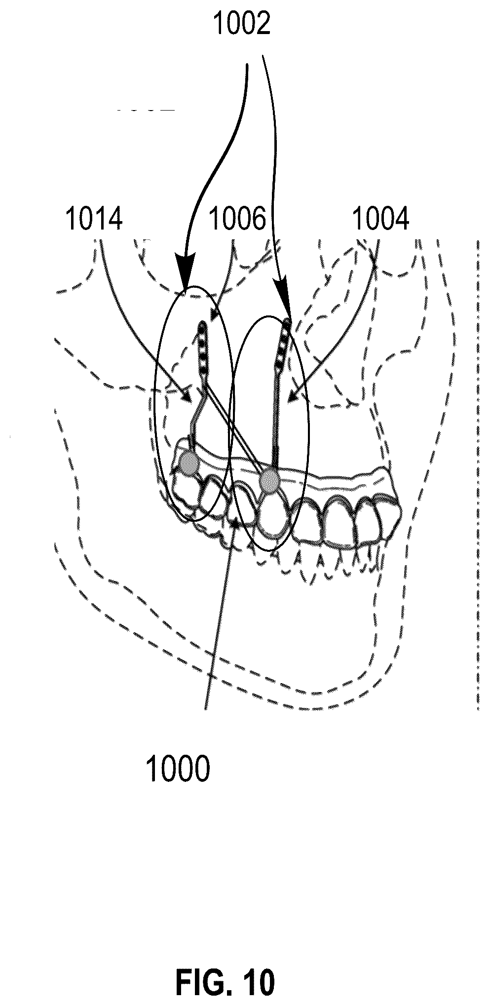 Patent US12551252 Figure 15 – Apparatus and method of an osteotomy for dental implant