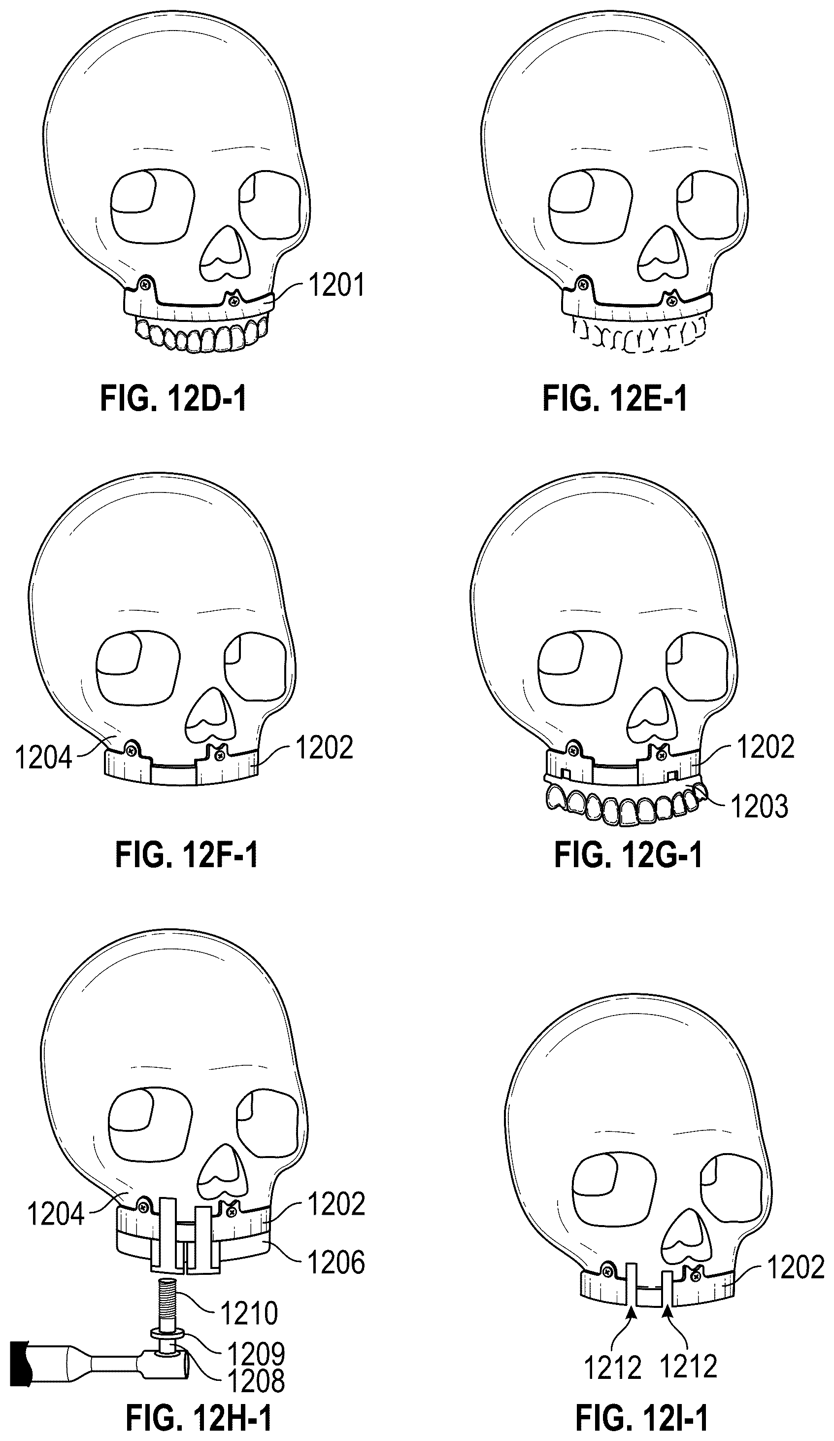 Patent US12551252 Figure 18 – Apparatus and method of an osteotomy for dental implant