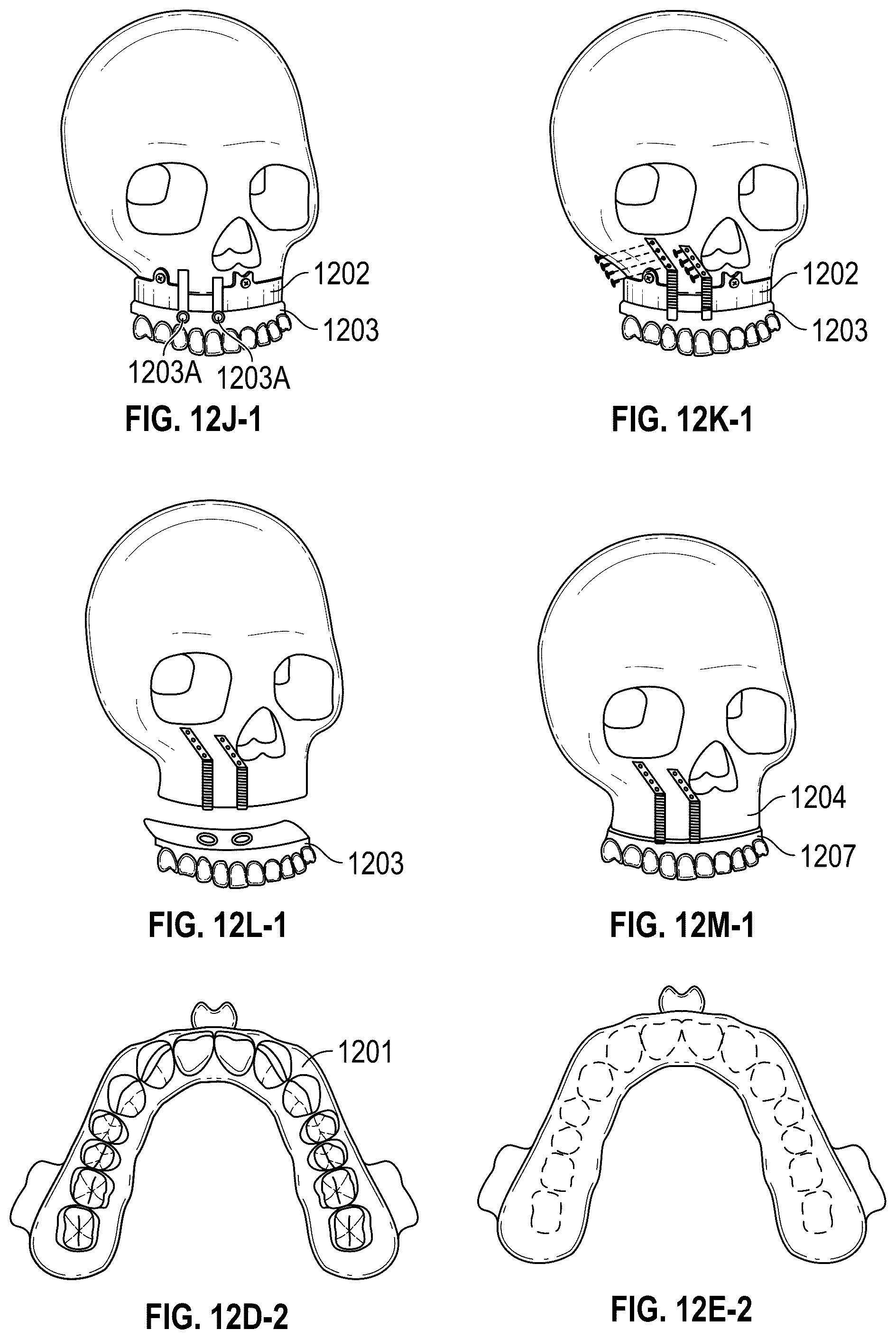 Patent US12551252 Figure 19 – Apparatus and method of an osteotomy for dental implant