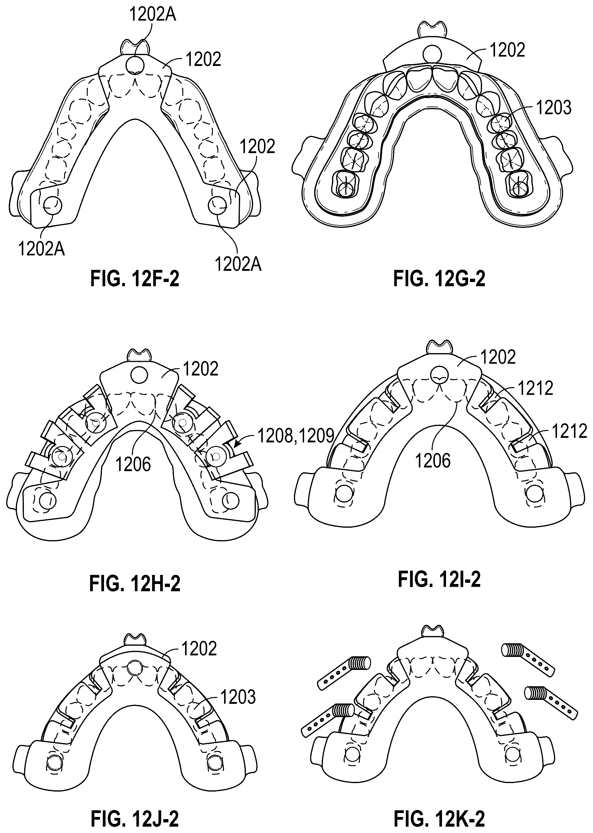 Patent US12551252 Figure 20 – Apparatus and method of an osteotomy for dental implant