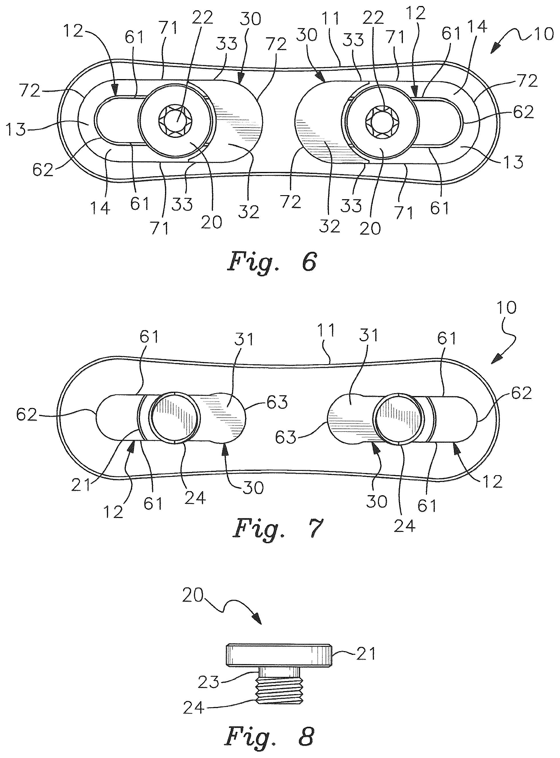Patent US12551253 Figure 3 – Pectus excavatum treating apparatus