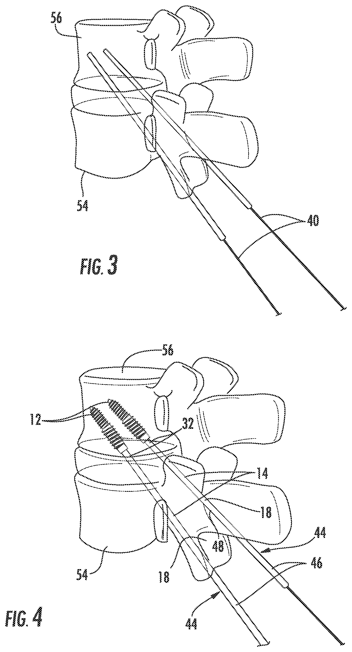 Patent US12551254 Figure 2 – Bone fusion system