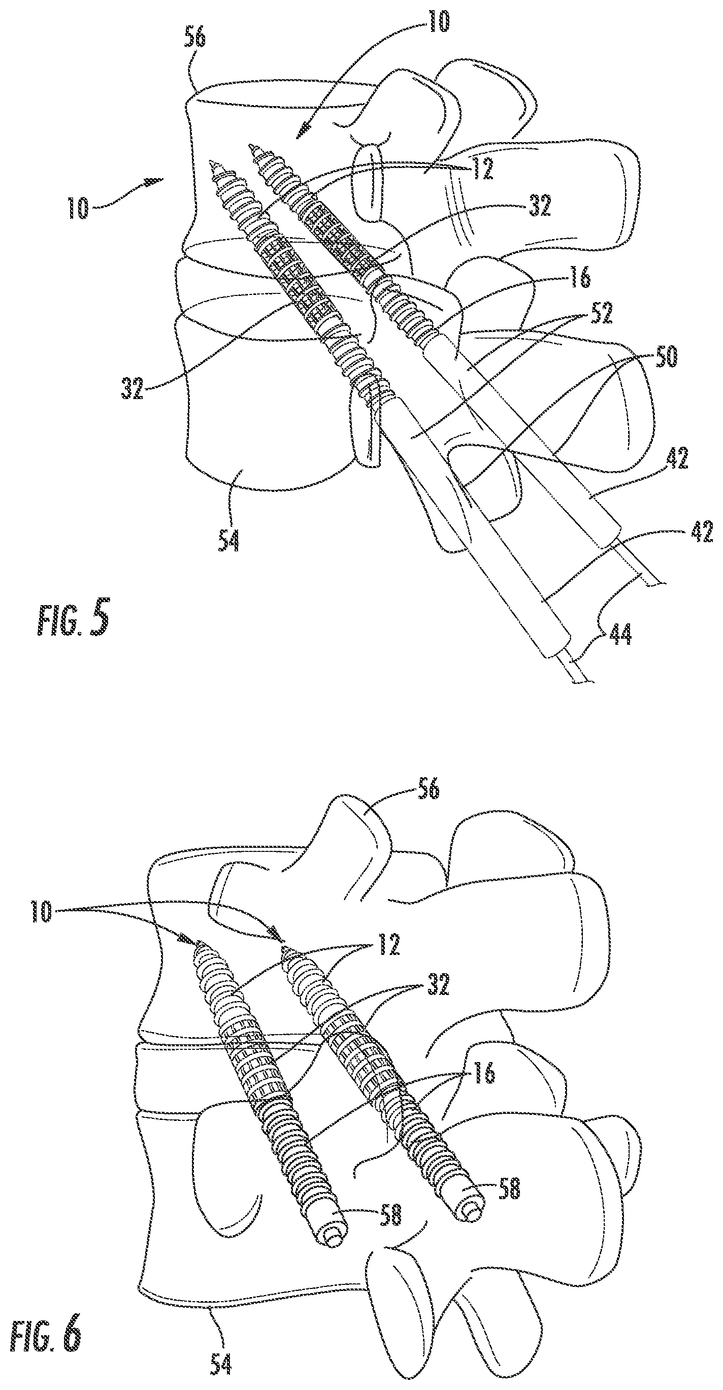 Patent US12551254 Figure 3 – Bone fusion system