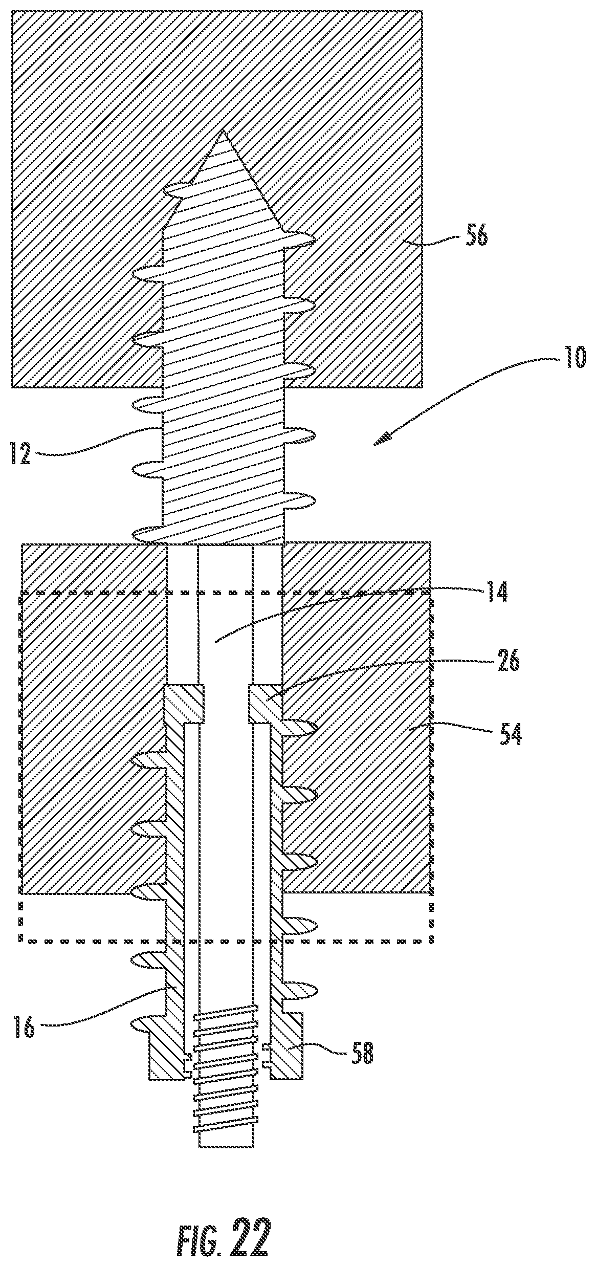 Patent US12551254 Figure 15 – Bone fusion system