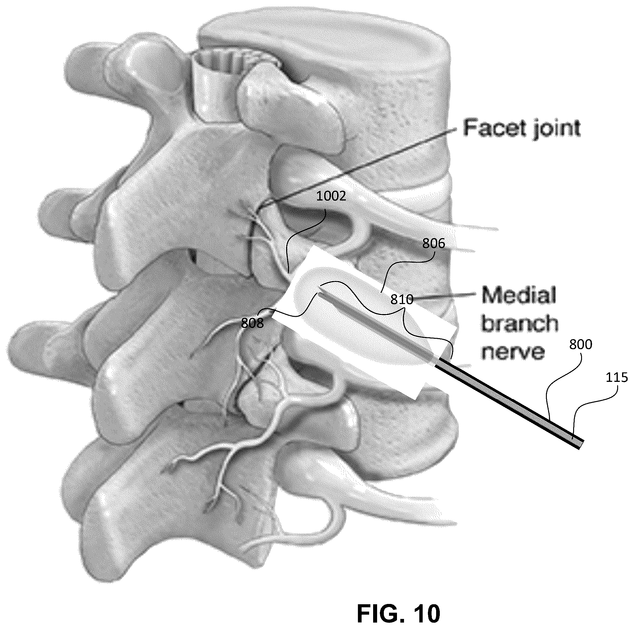Patent US12551258 Figure 11 – Medial branch smart tip needle