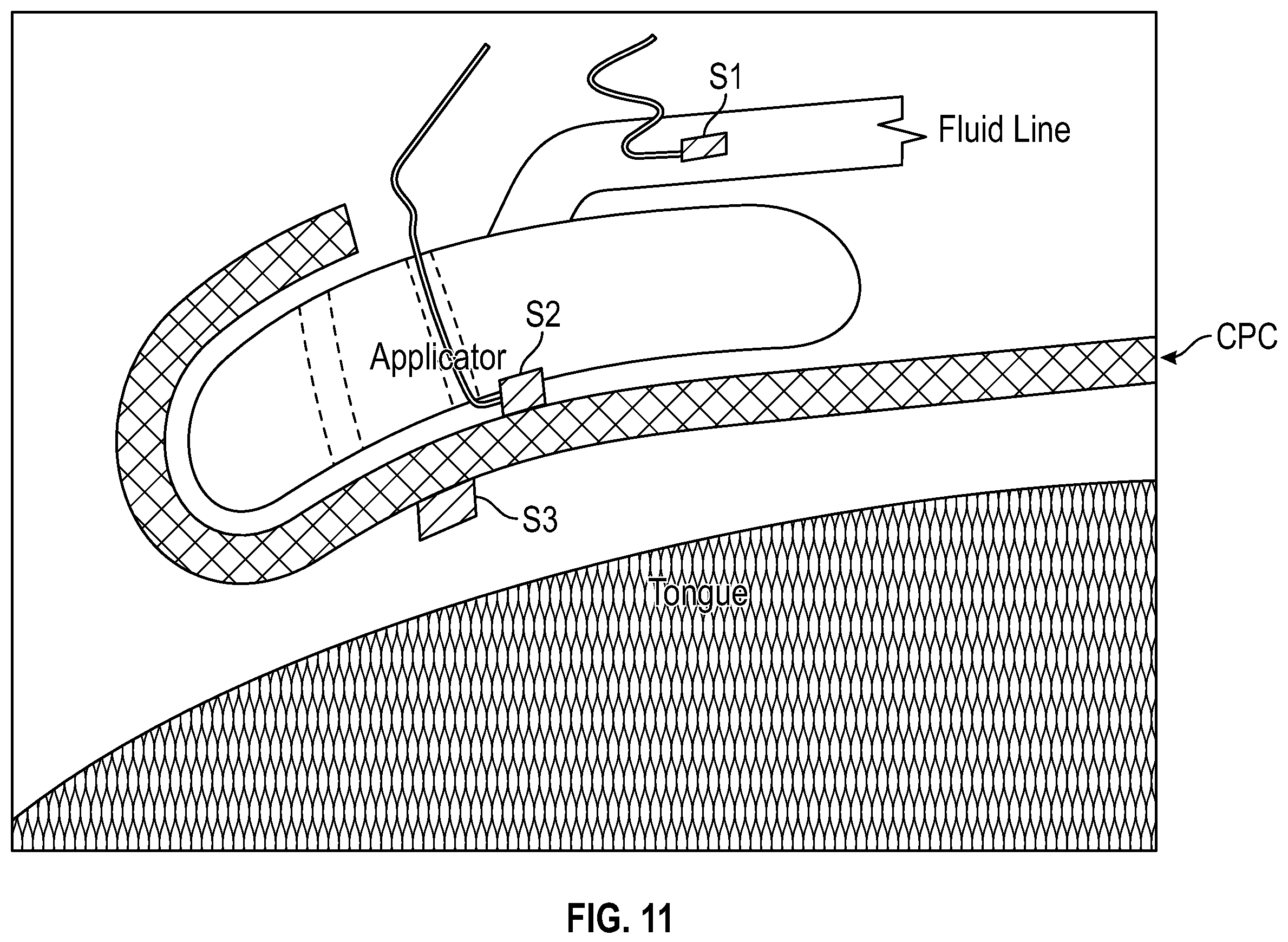 Patent US12551259 Figure 15 – Systems and methods for treatment of obstructive sleep apnea