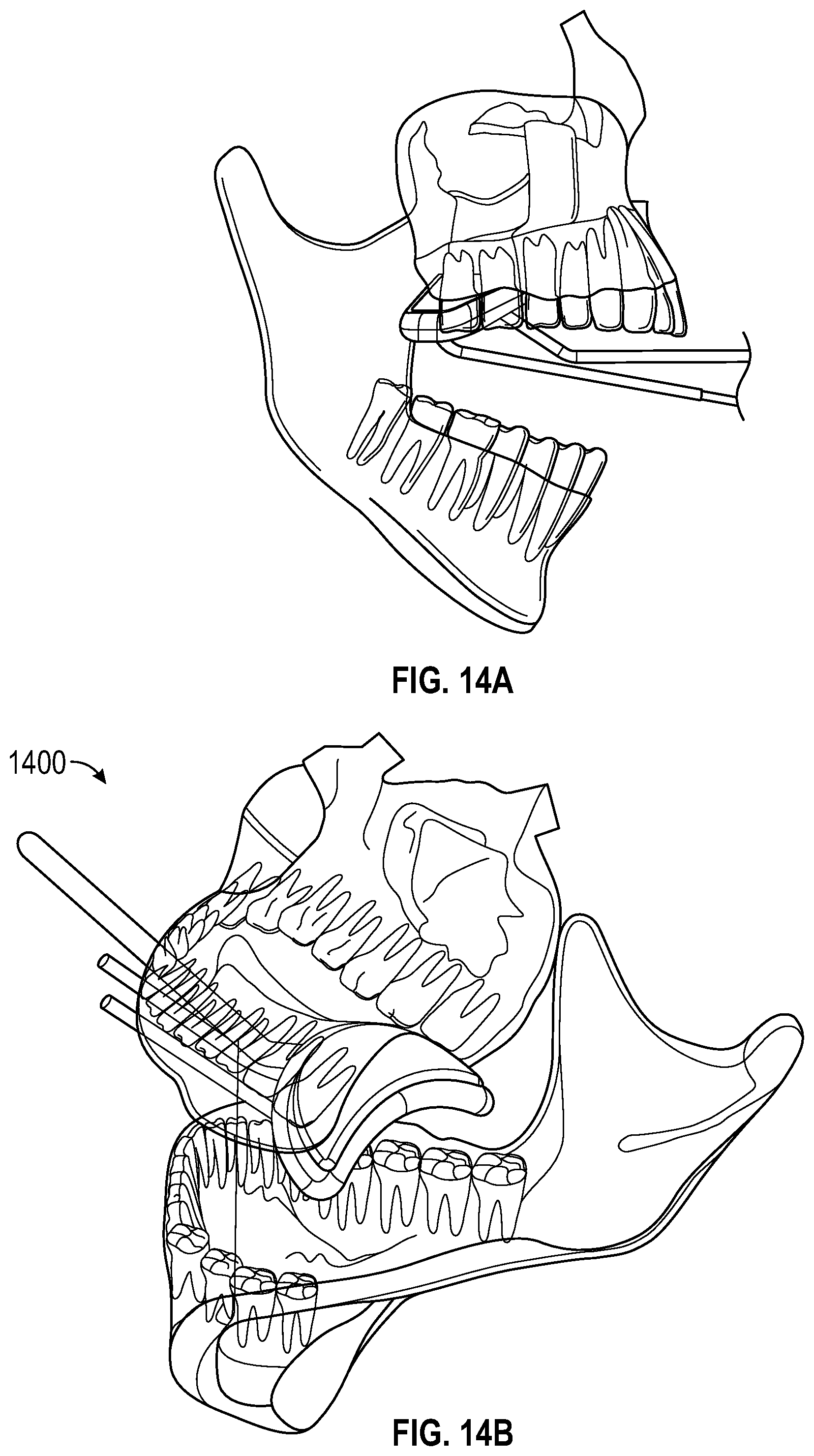 Patent US12551259 Figure 18 – Systems and methods for treatment of obstructive sleep apnea