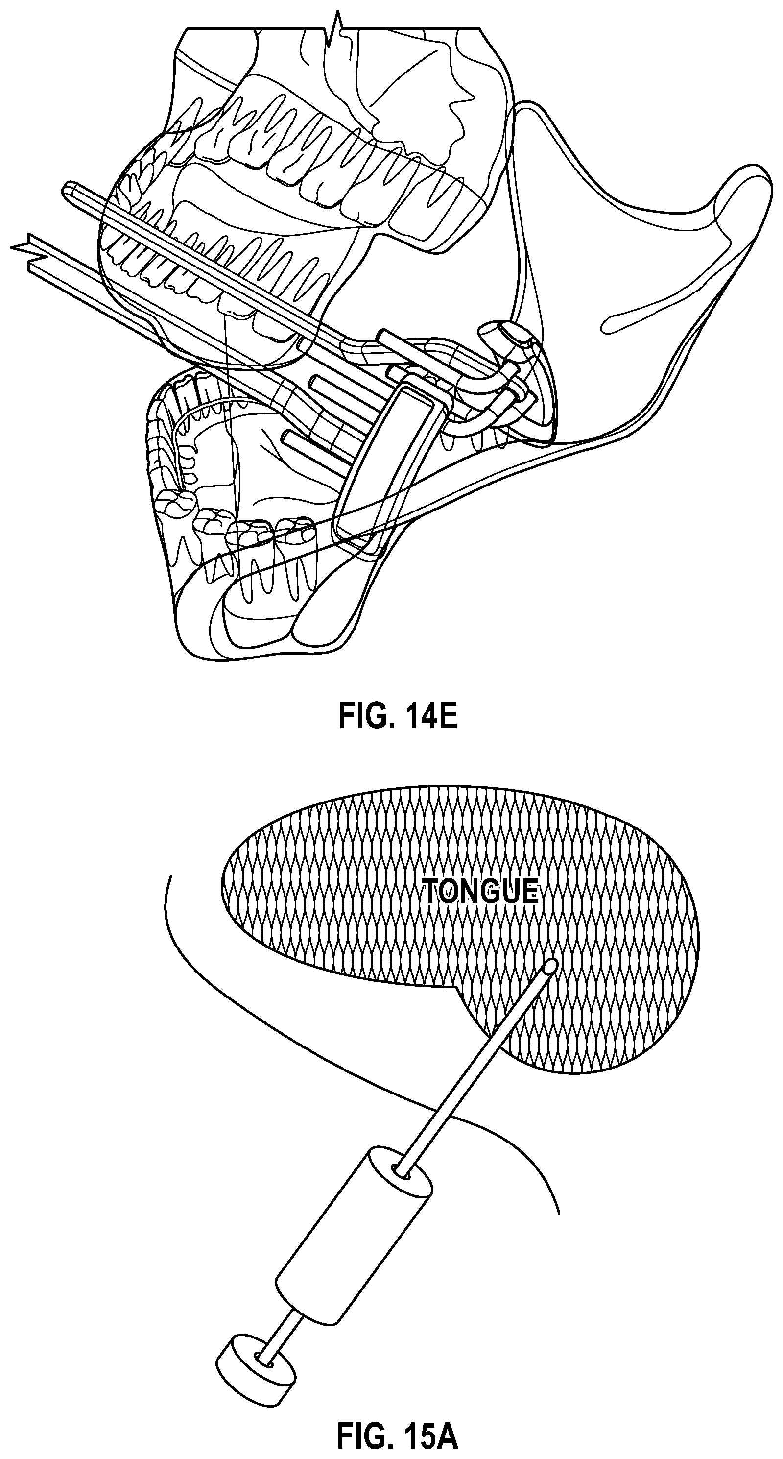 Patent US12551259 Figure 20 – Systems and methods for treatment of obstructive sleep apnea