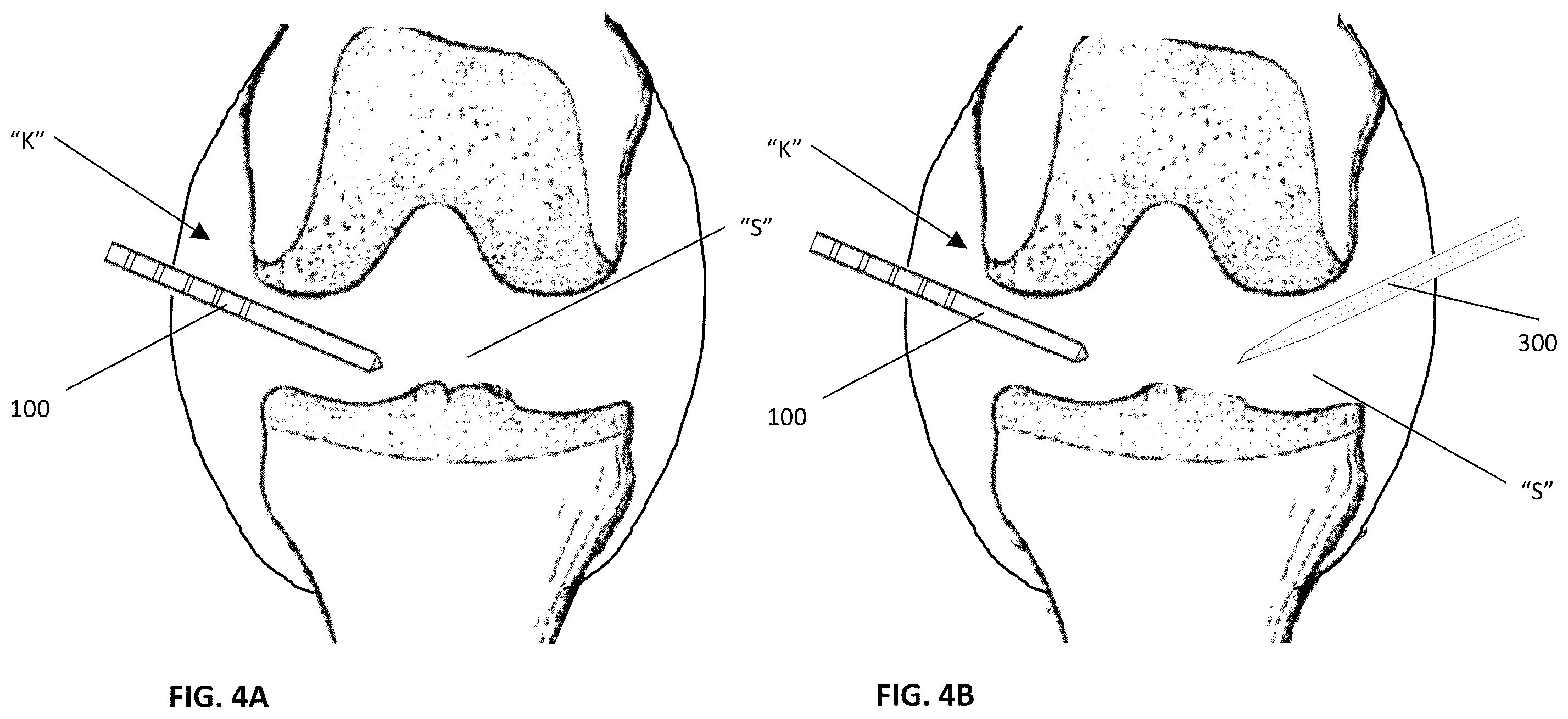 Patent US12551260 Figure 4 – Devices, systems, and methods for energy-based treatment of synovial joints and other fluid-filled spaces