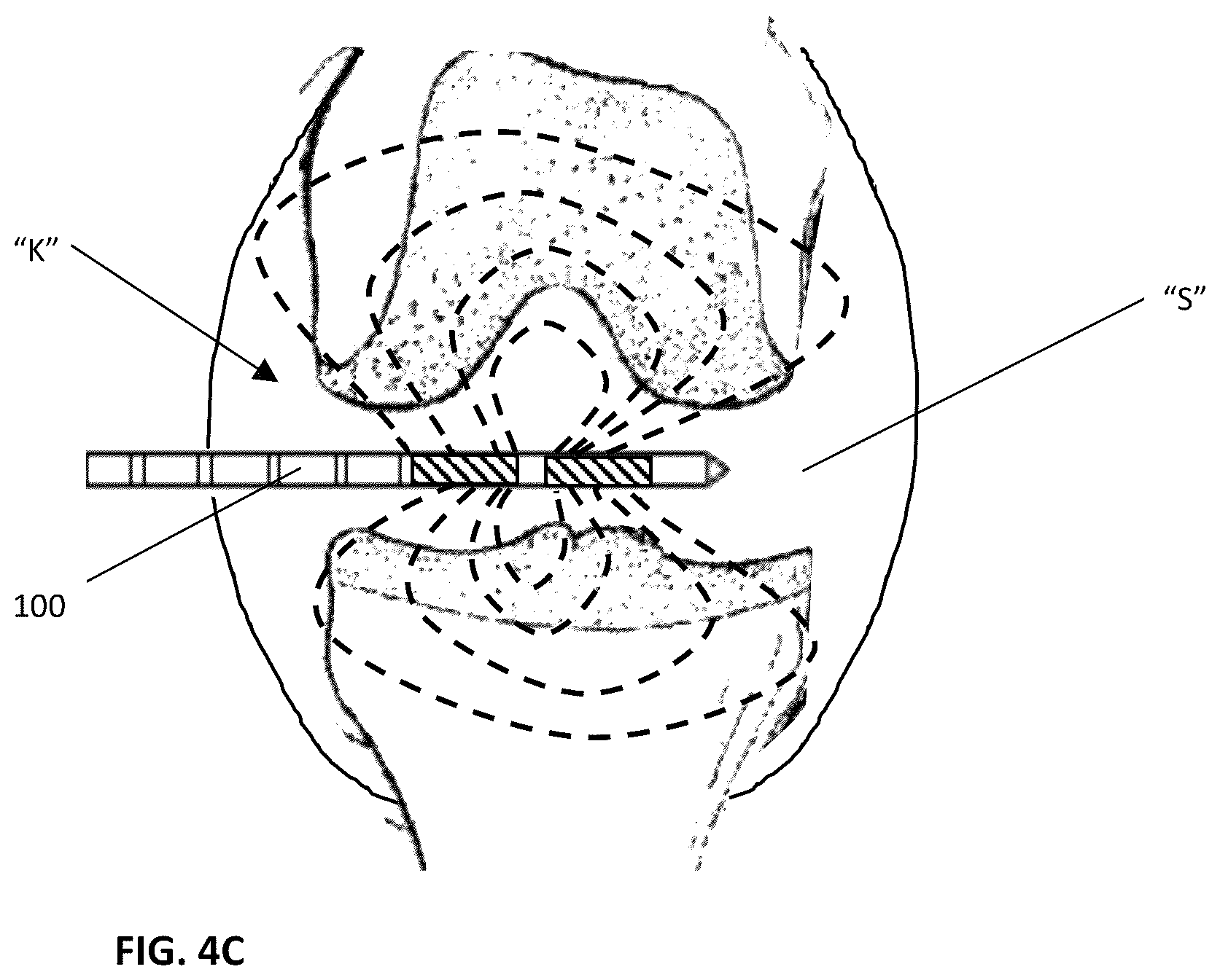 Patent US12551260 Figure 5 – Devices, systems, and methods for energy-based treatment of synovial joints and other fluid-filled spaces