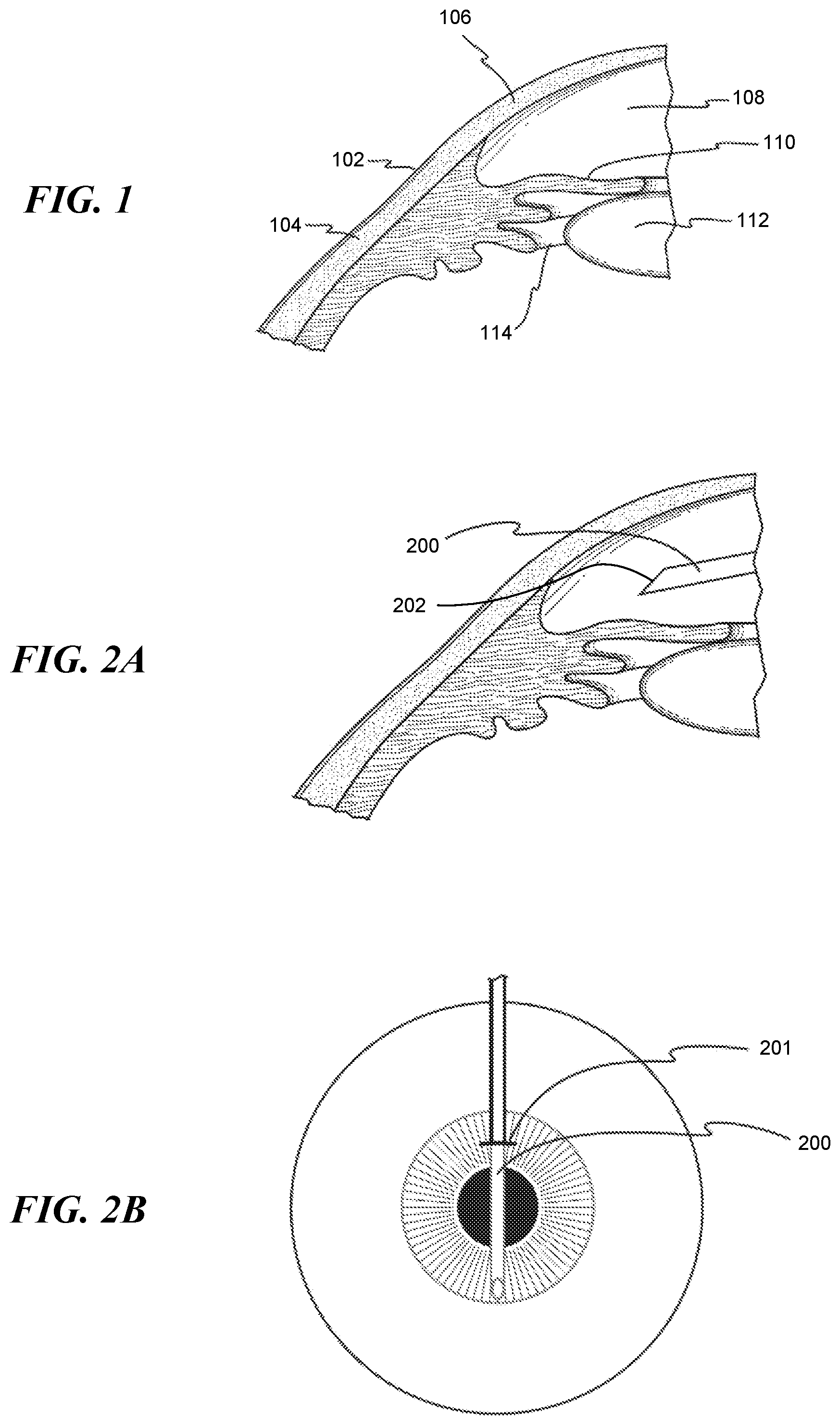 Patent US12551268 Figure 1 – Minimally invasive bleb formation devices and methods for using such devices