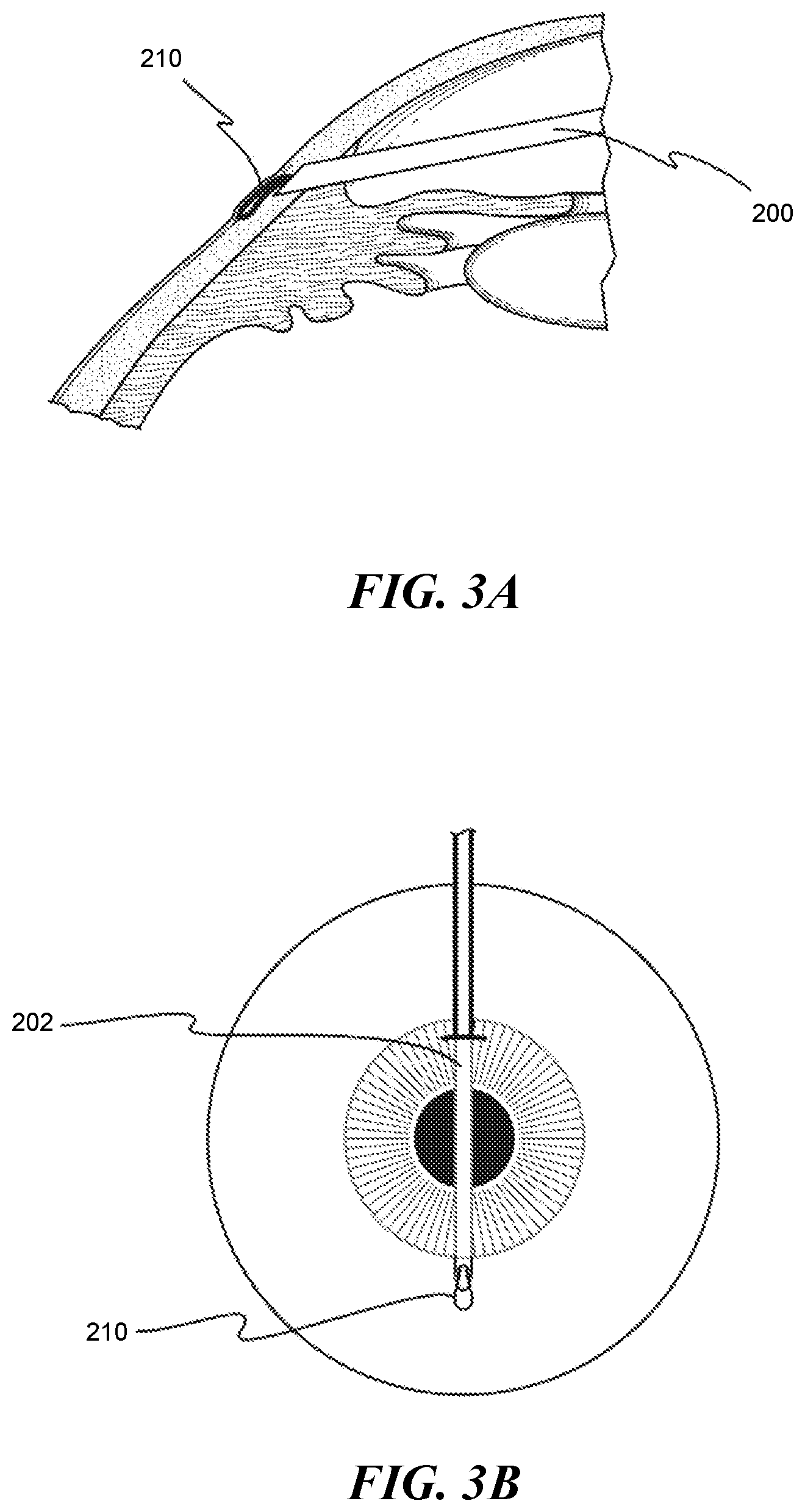 Patent US12551268 Figure 2 – Minimally invasive bleb formation devices and methods for using such devices