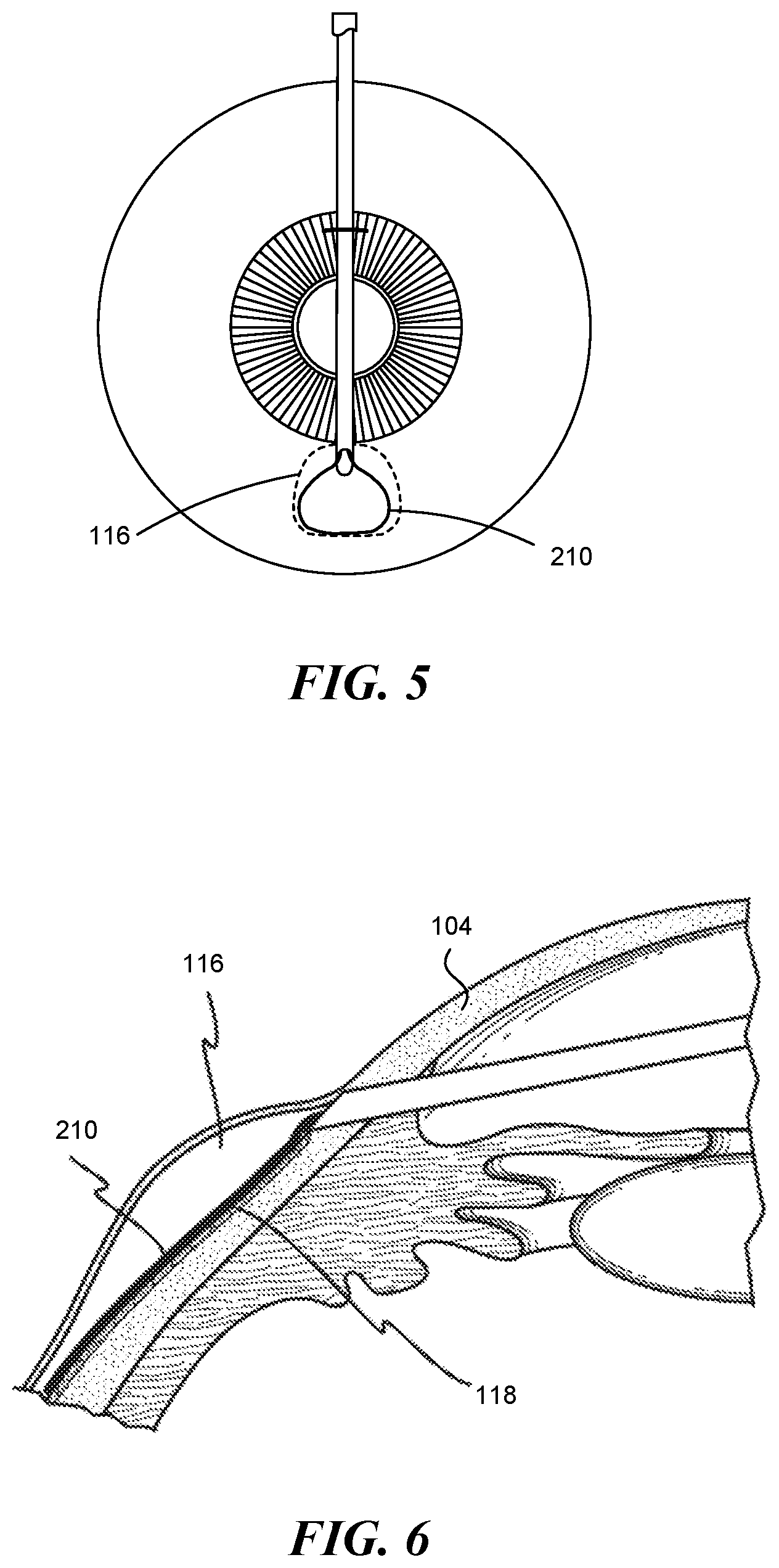 Patent US12551268 Figure 4 – Minimally invasive bleb formation devices and methods for using such devices