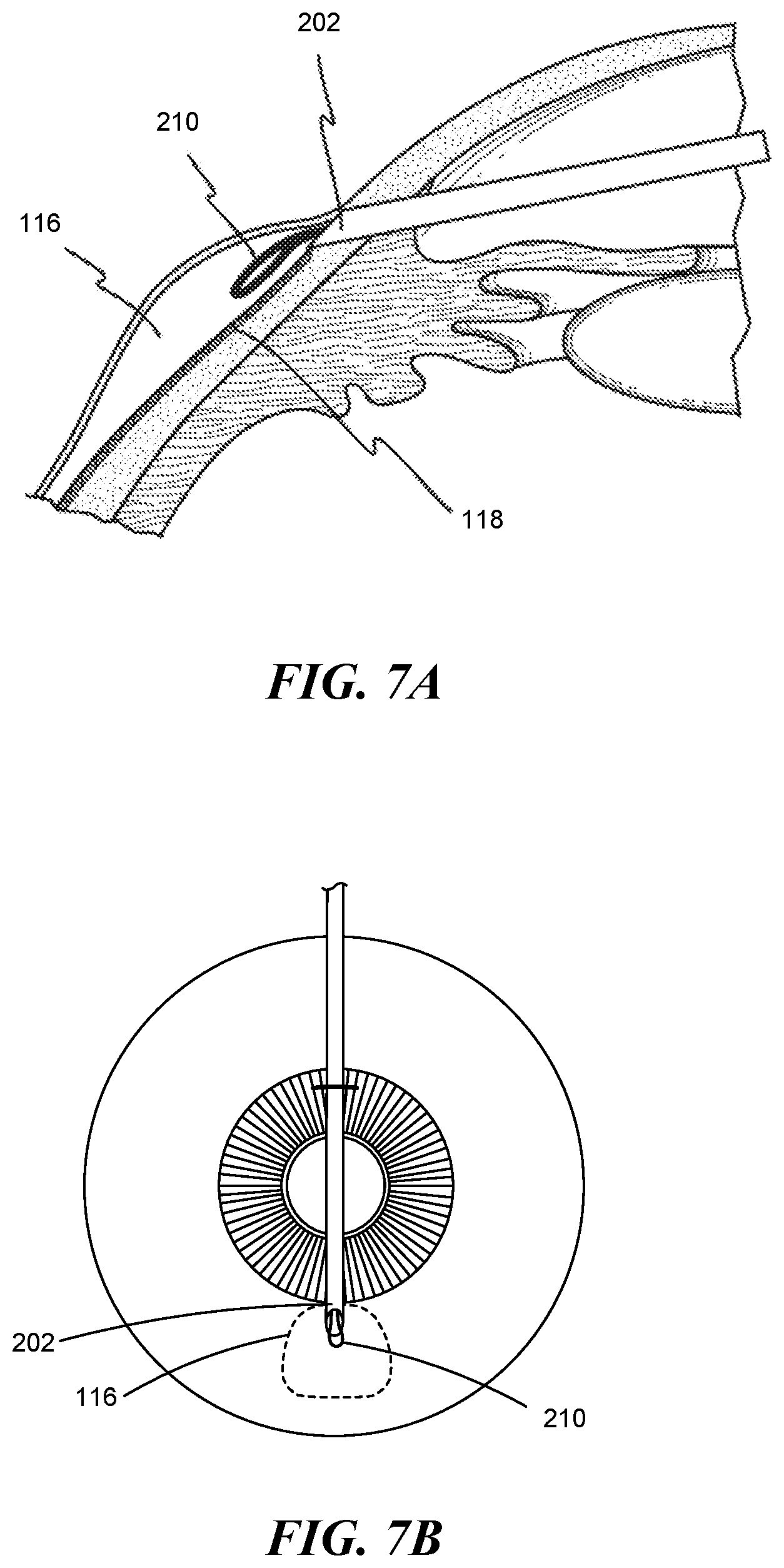 Patent US12551268 Figure 5 – Minimally invasive bleb formation devices and methods for using such devices