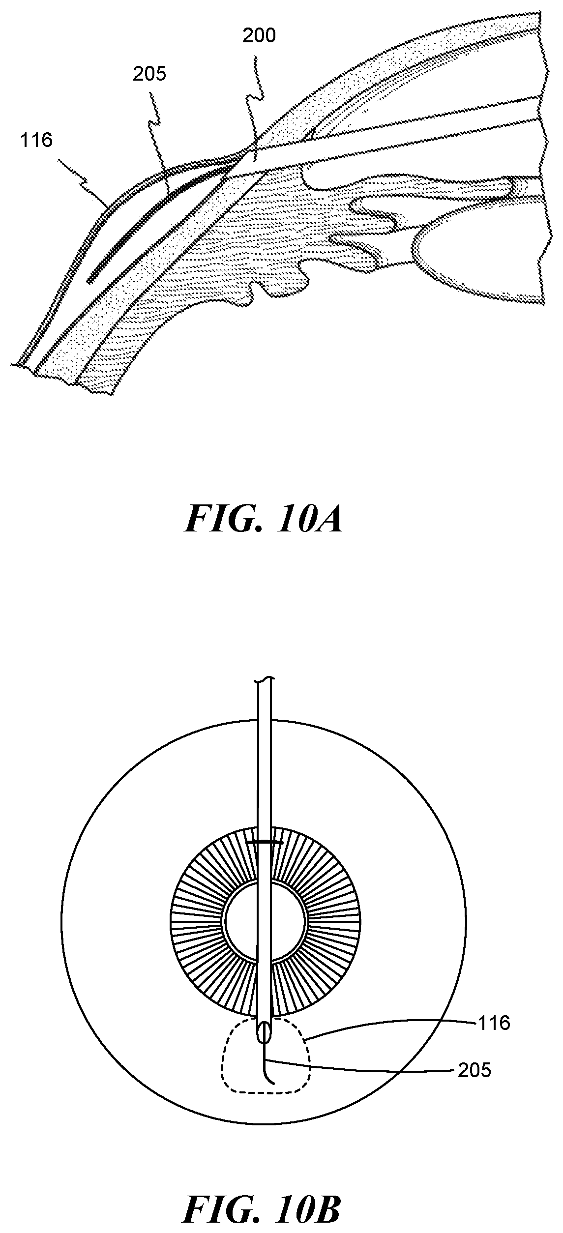 Patent US12551268 Figure 7 – Minimally invasive bleb formation devices and methods for using such devices