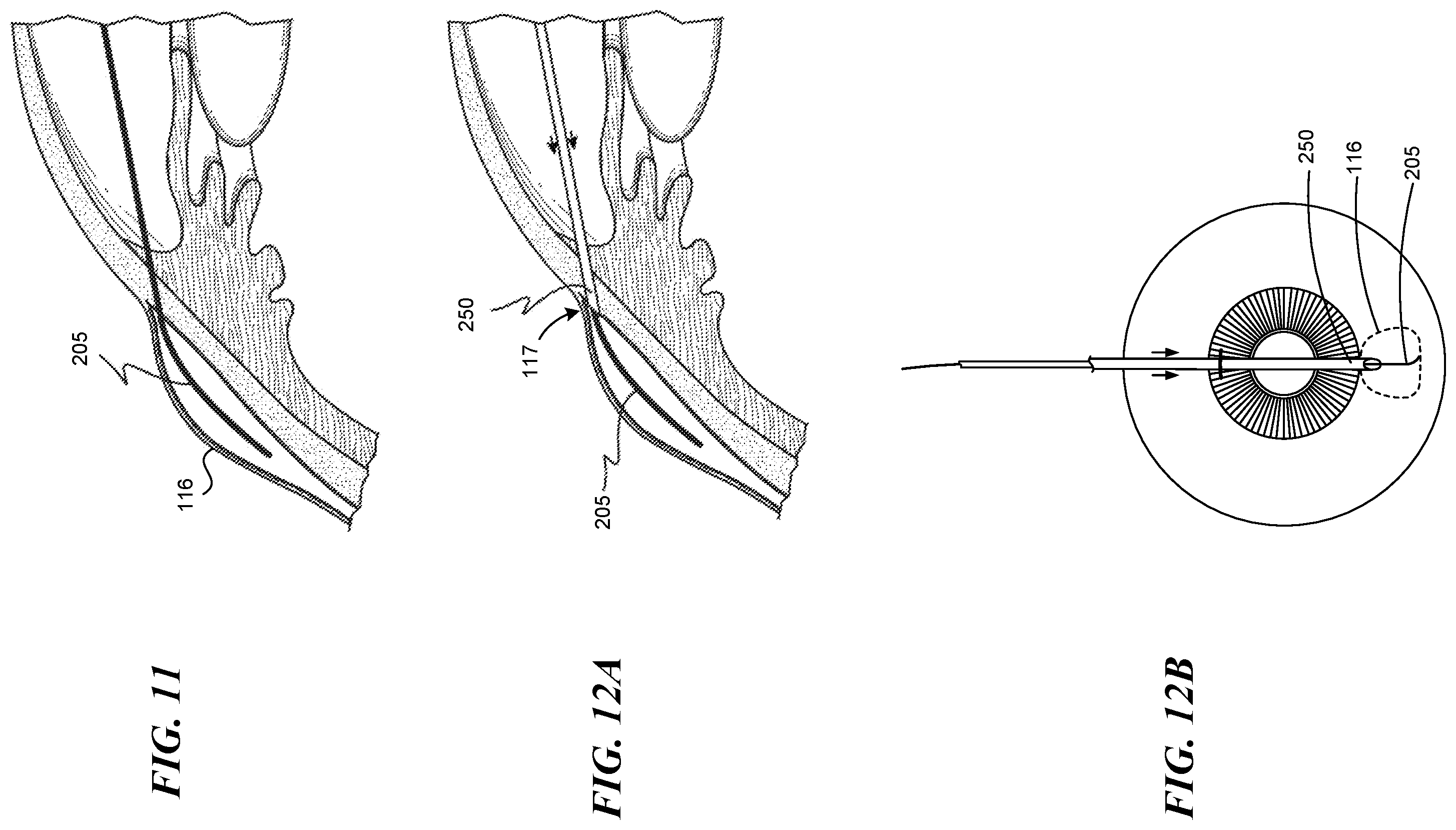 Patent US12551268 Figure 8 – Minimally invasive bleb formation devices and methods for using such devices