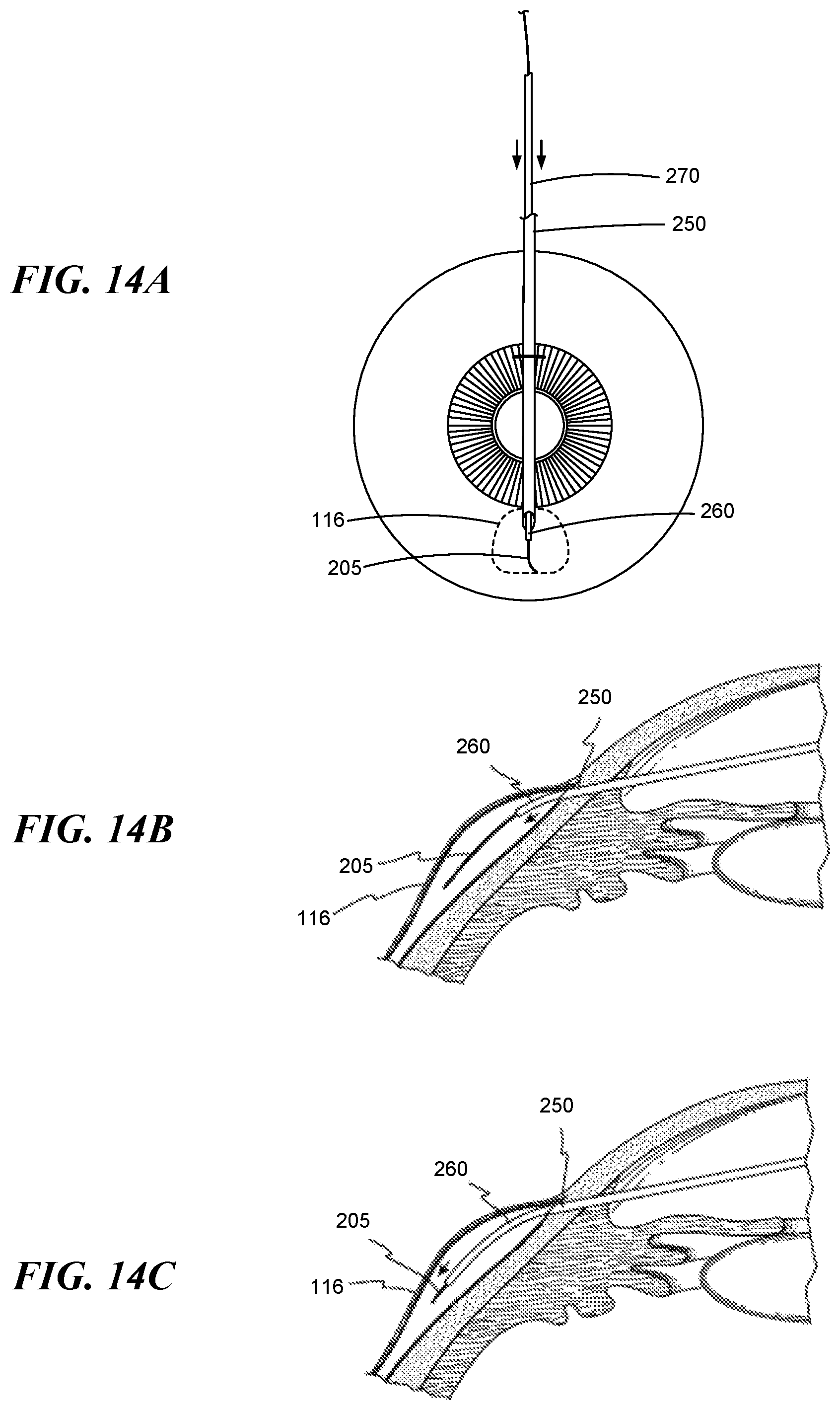 Patent US12551268 Figure 10 – Minimally invasive bleb formation devices and methods for using such devices