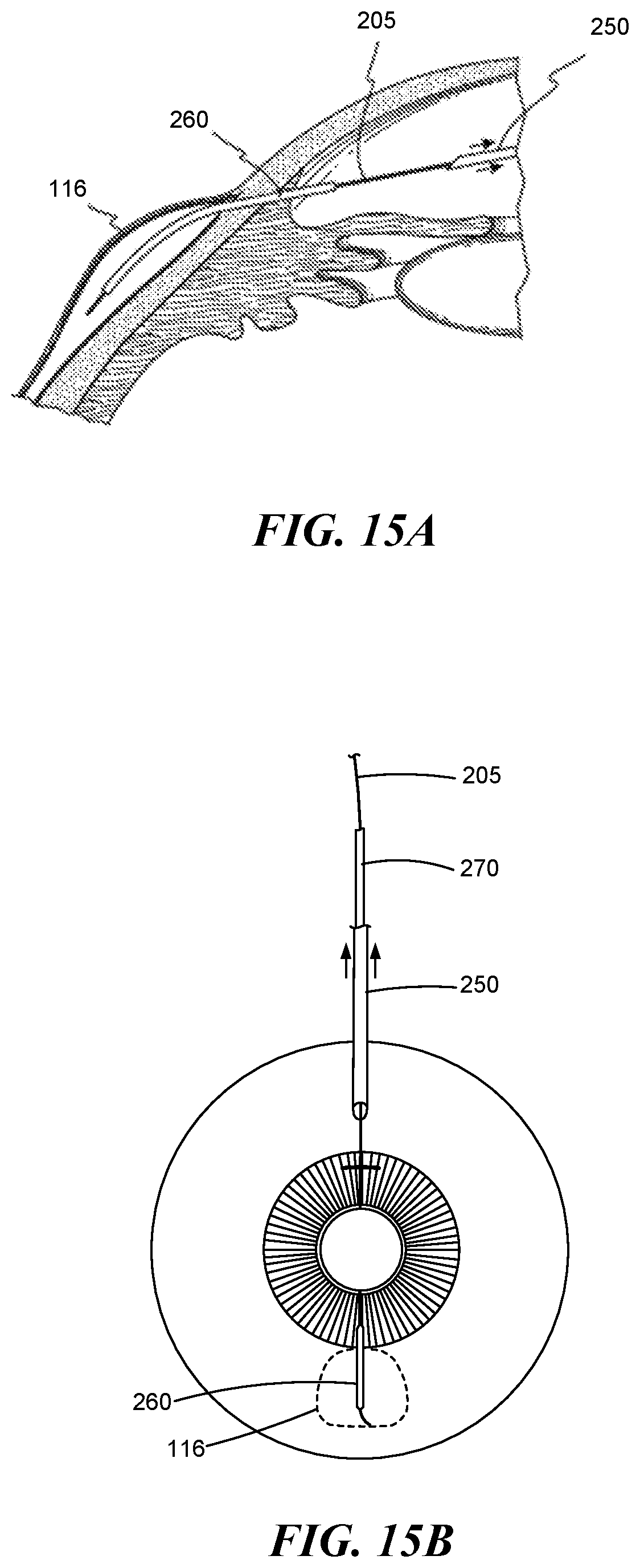Patent US12551268 Figure 11 – Minimally invasive bleb formation devices and methods for using such devices