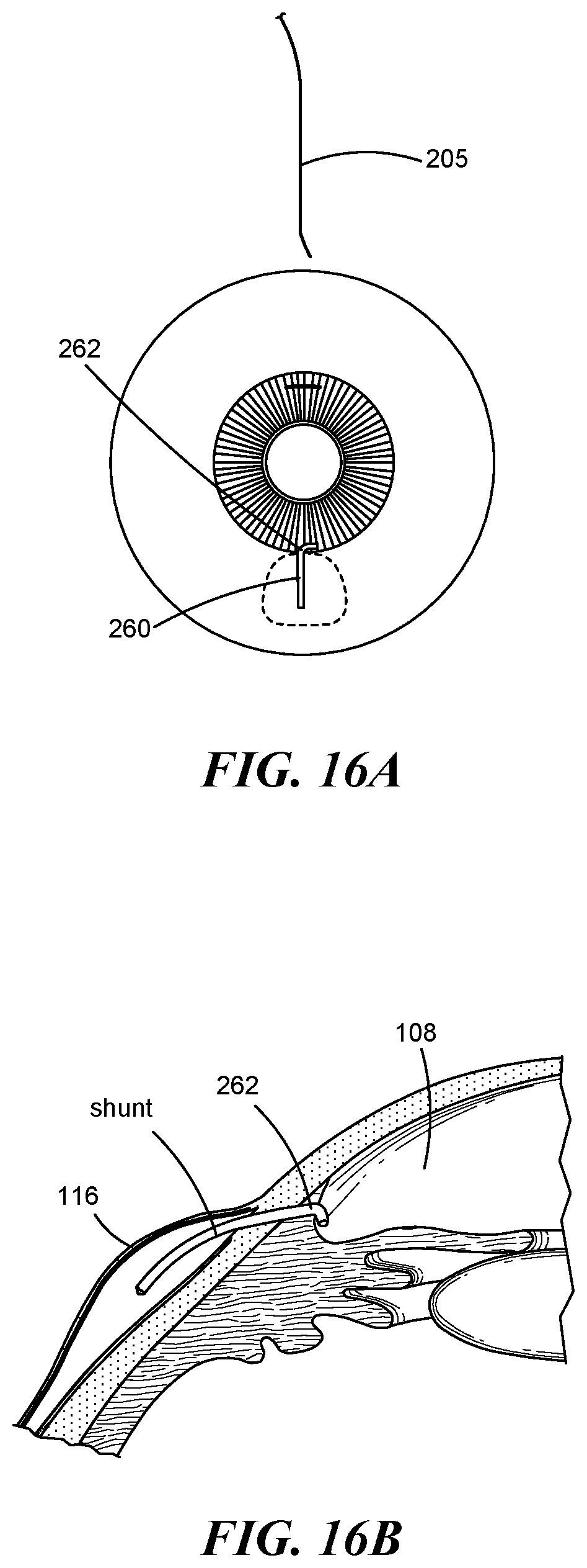 Patent US12551268 Figure 12 – Minimally invasive bleb formation devices and methods for using such devices
