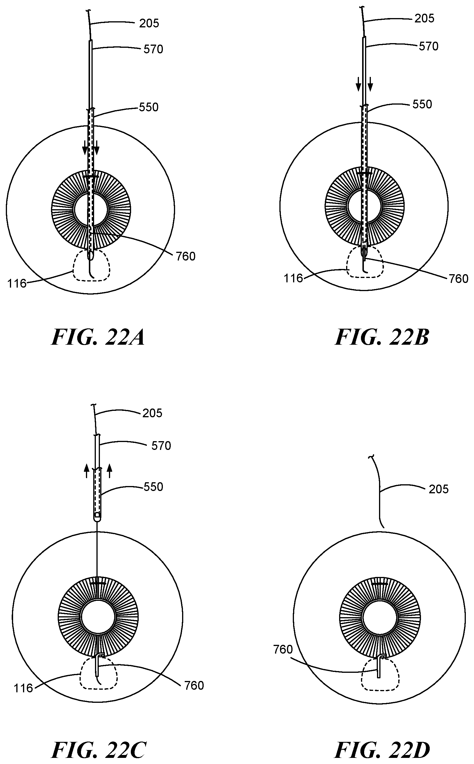 Patent US12551268 Figure 18 – Minimally invasive bleb formation devices and methods for using such devices