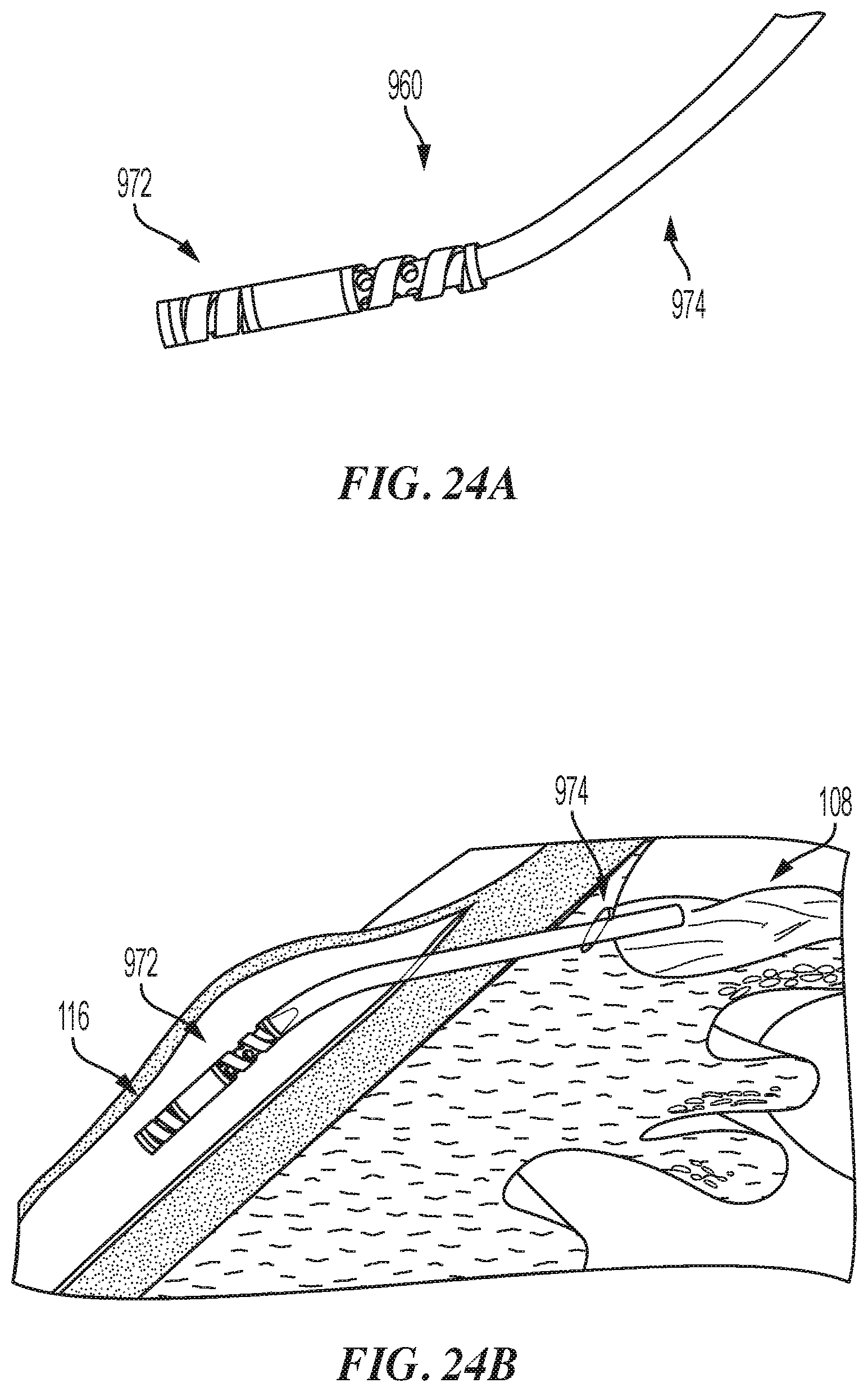 Patent US12551268 Figure 20 – Minimally invasive bleb formation devices and methods for using such devices