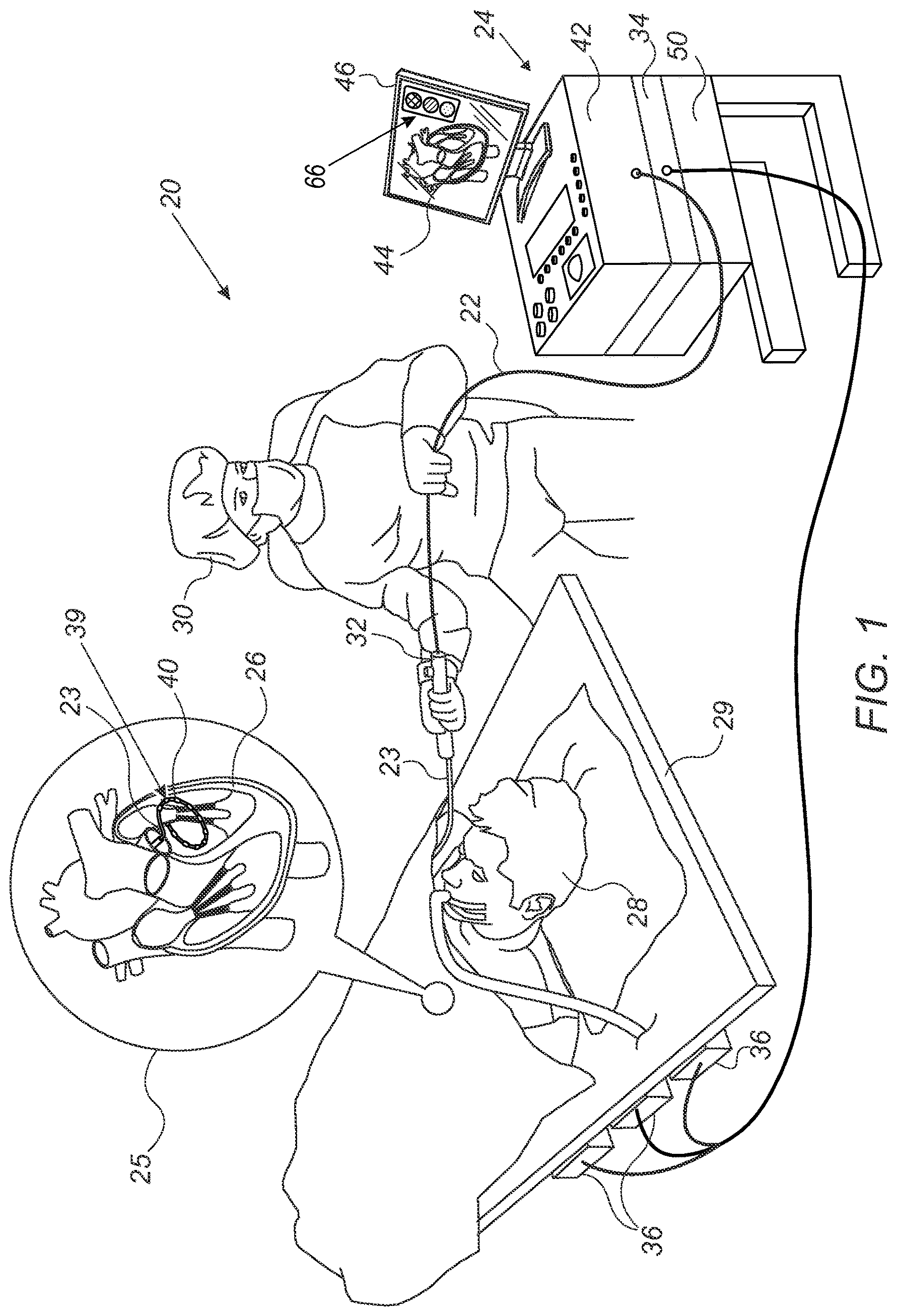 Patent US12551269 — Displaying indications of mutual distances among electrodes of a flexible ablation catheter — Figure 1