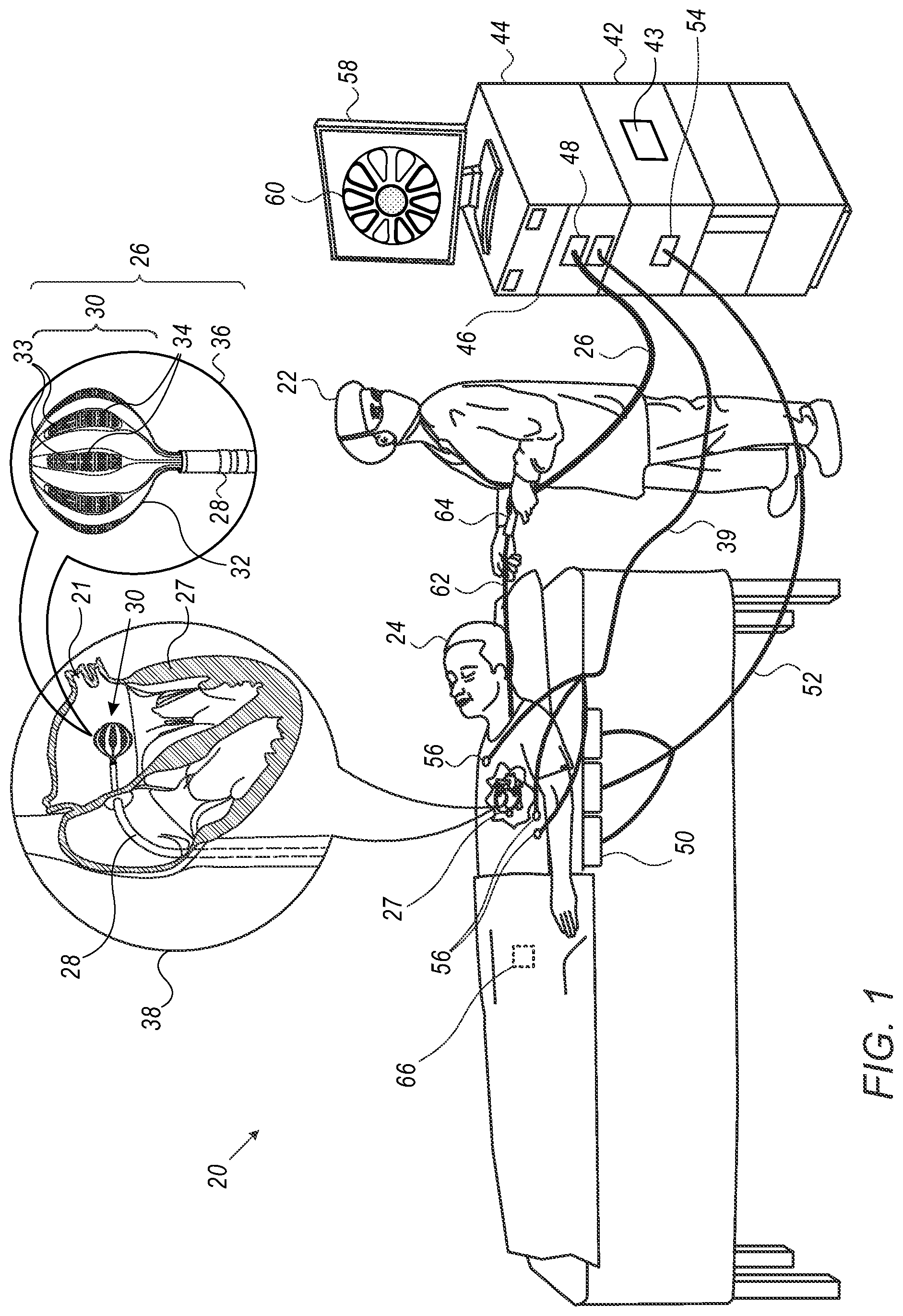 Patent US12551270 Figure 1 – Graphical contact quality indicator for balloon catheter navigation