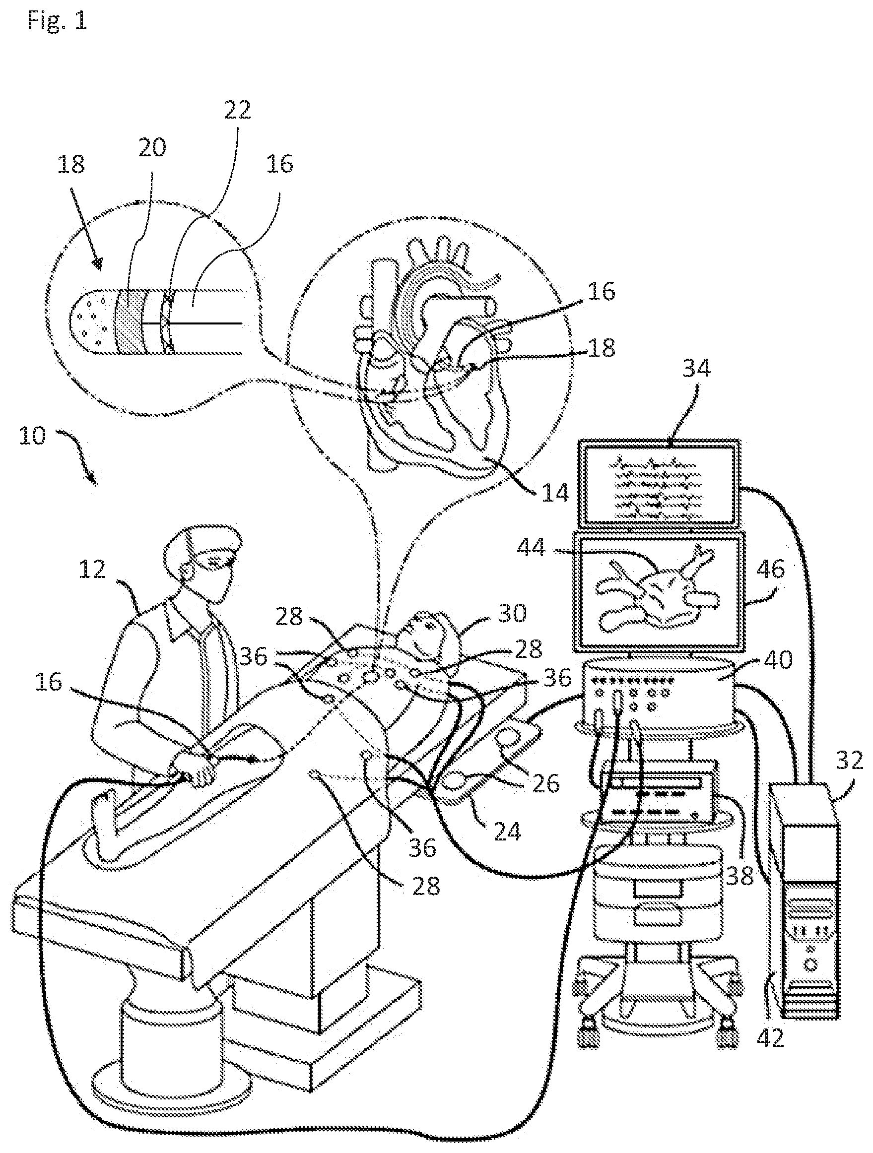 Patent US12551272 Figure 1 – Precise irrigation rate for ablation catheter