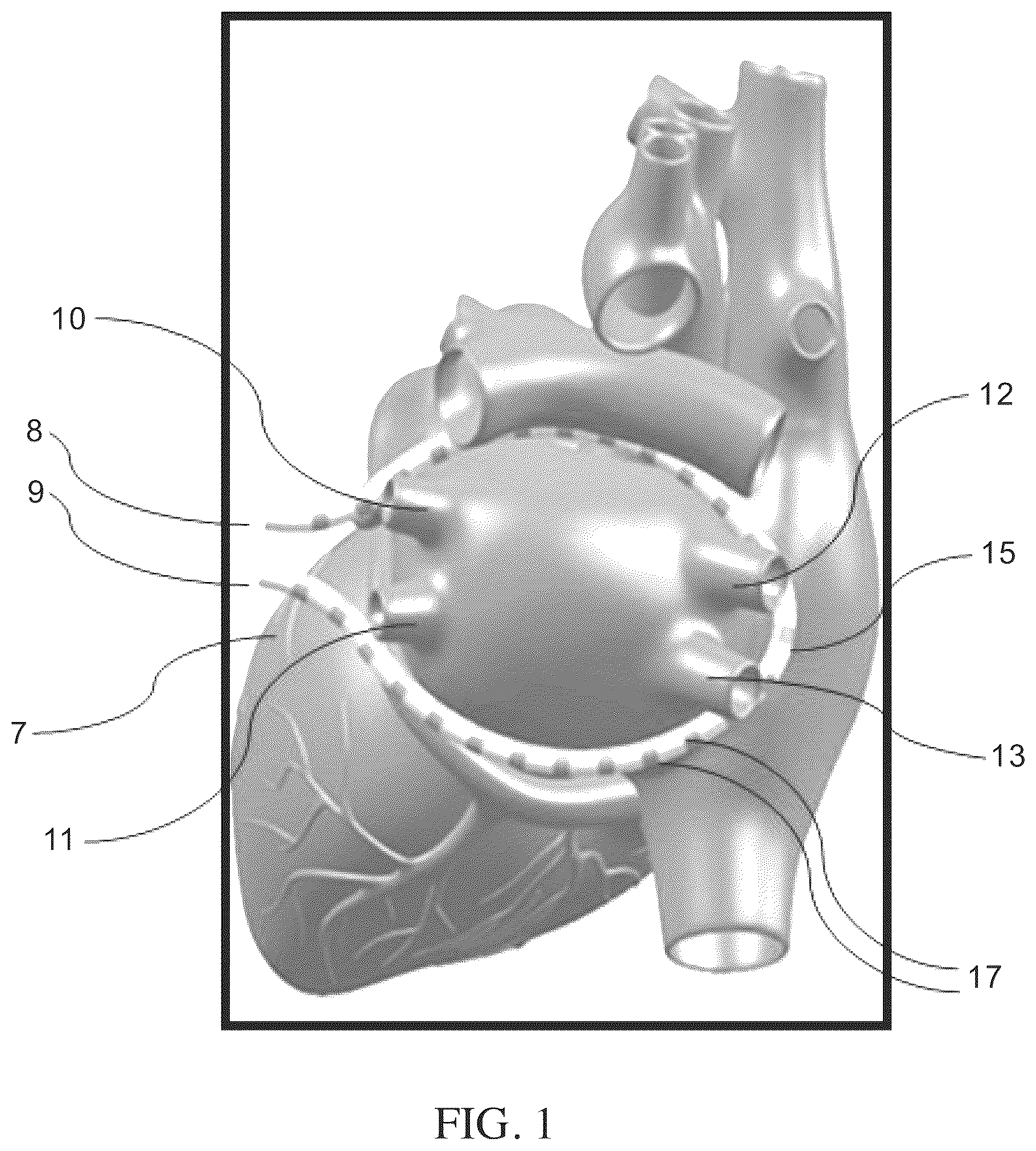 Patent US12551274 Figure 1 – Methods and apparatus for selective tissue ablation