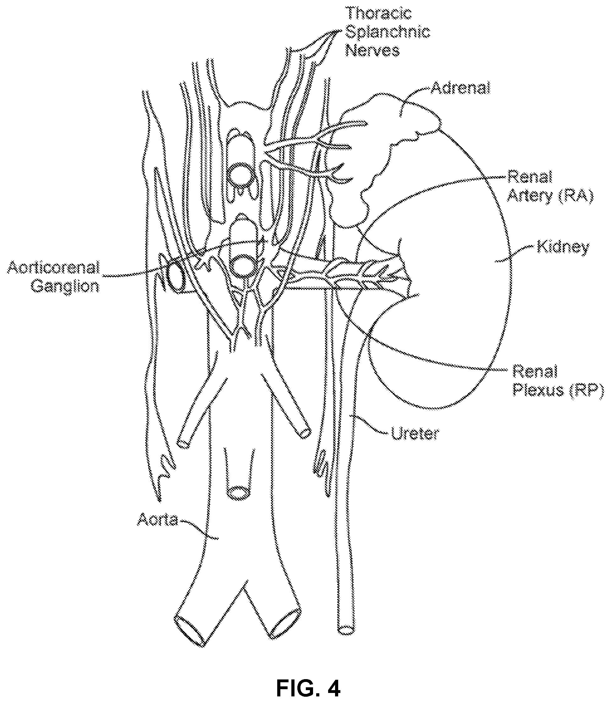 Patent US12551282 Figure 4 – Percutaneous medical device navigation system